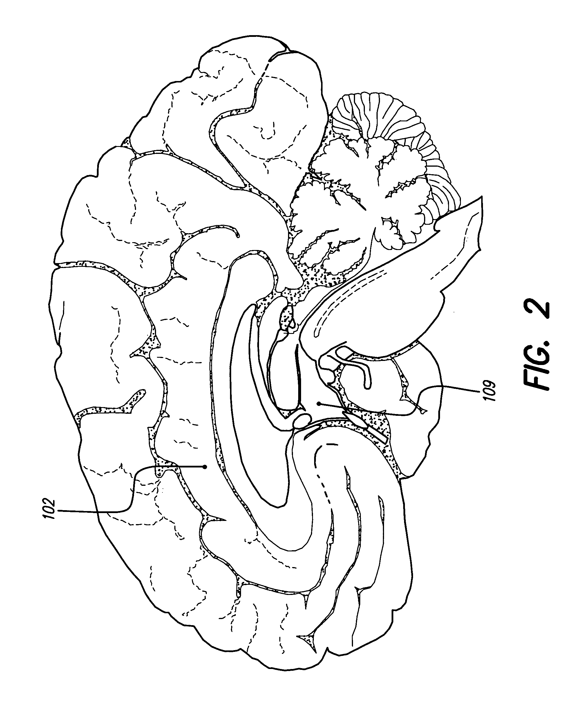 Treatment of mood and/or anxiety disorders by electrical brain stimulation and/or drug infusion