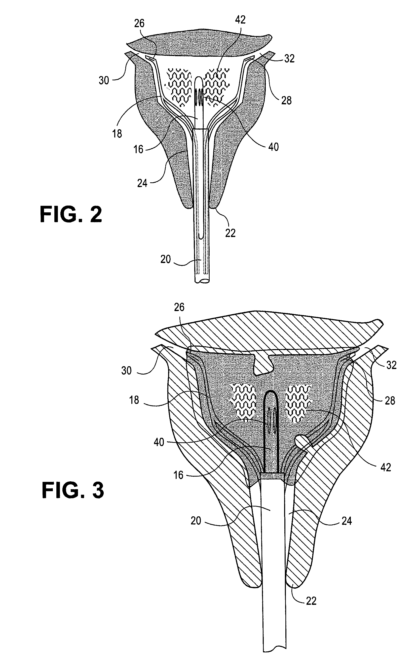 Uterine therapy device and method