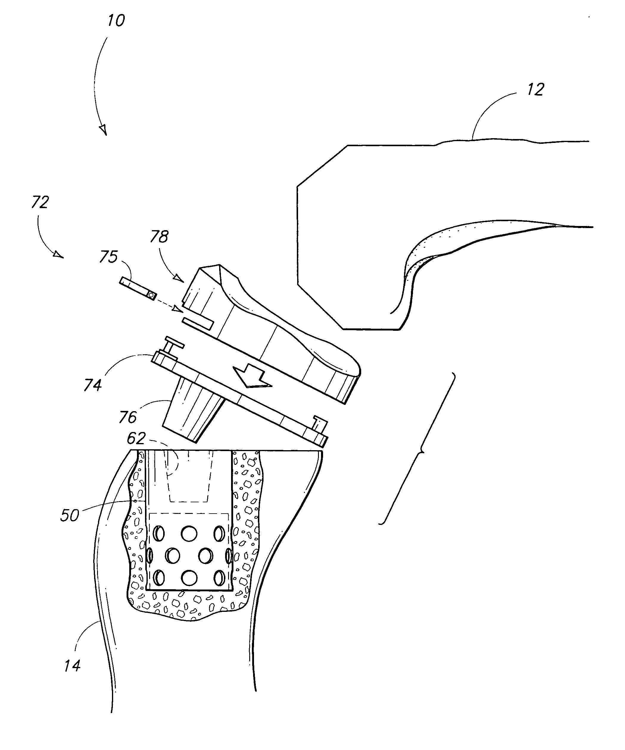 Joint replacement prosthesis, joint replacement mounting stud and method