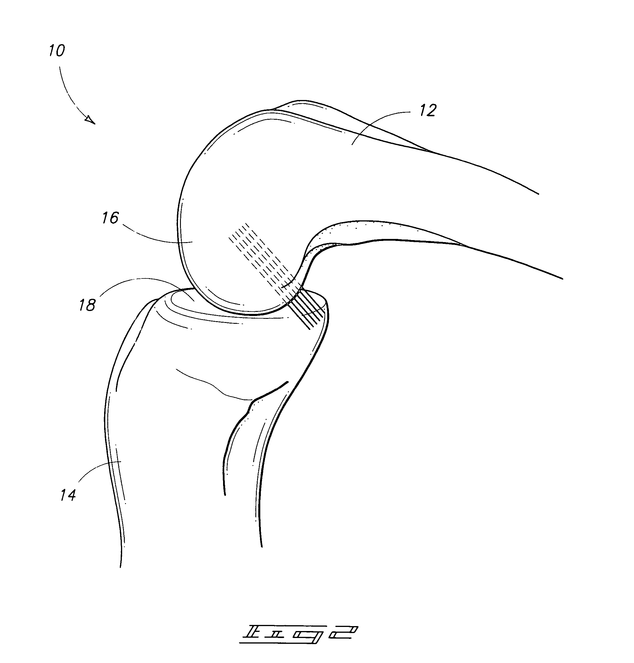 Joint replacement prosthesis, joint replacement mounting stud and method