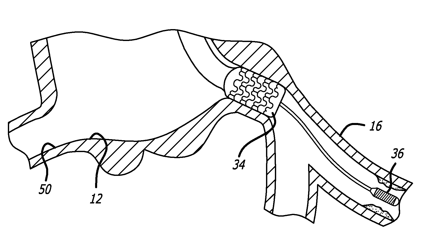 Methods for implanting a stent using a guide catheter