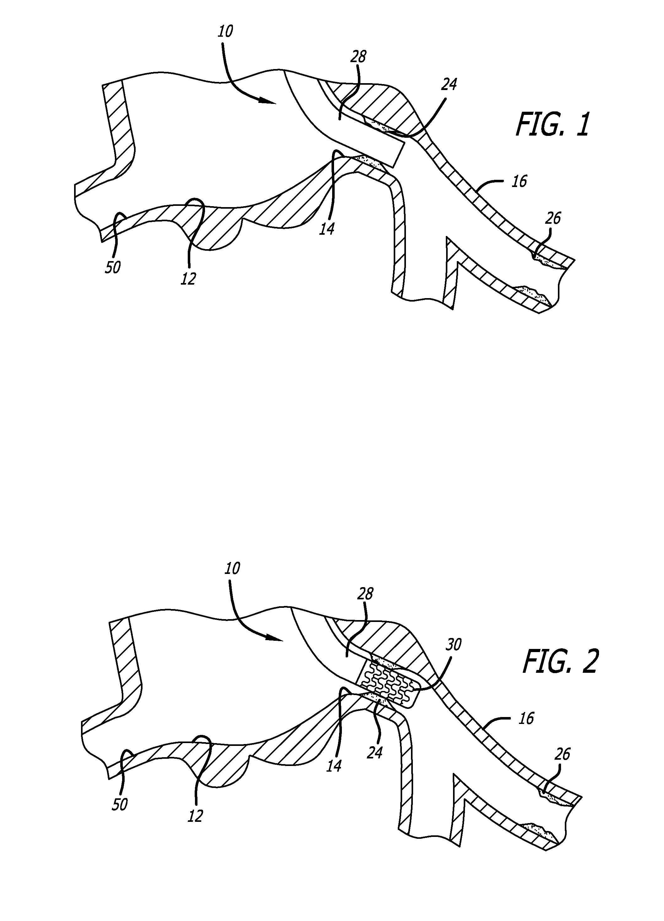 Methods for implanting a stent using a guide catheter