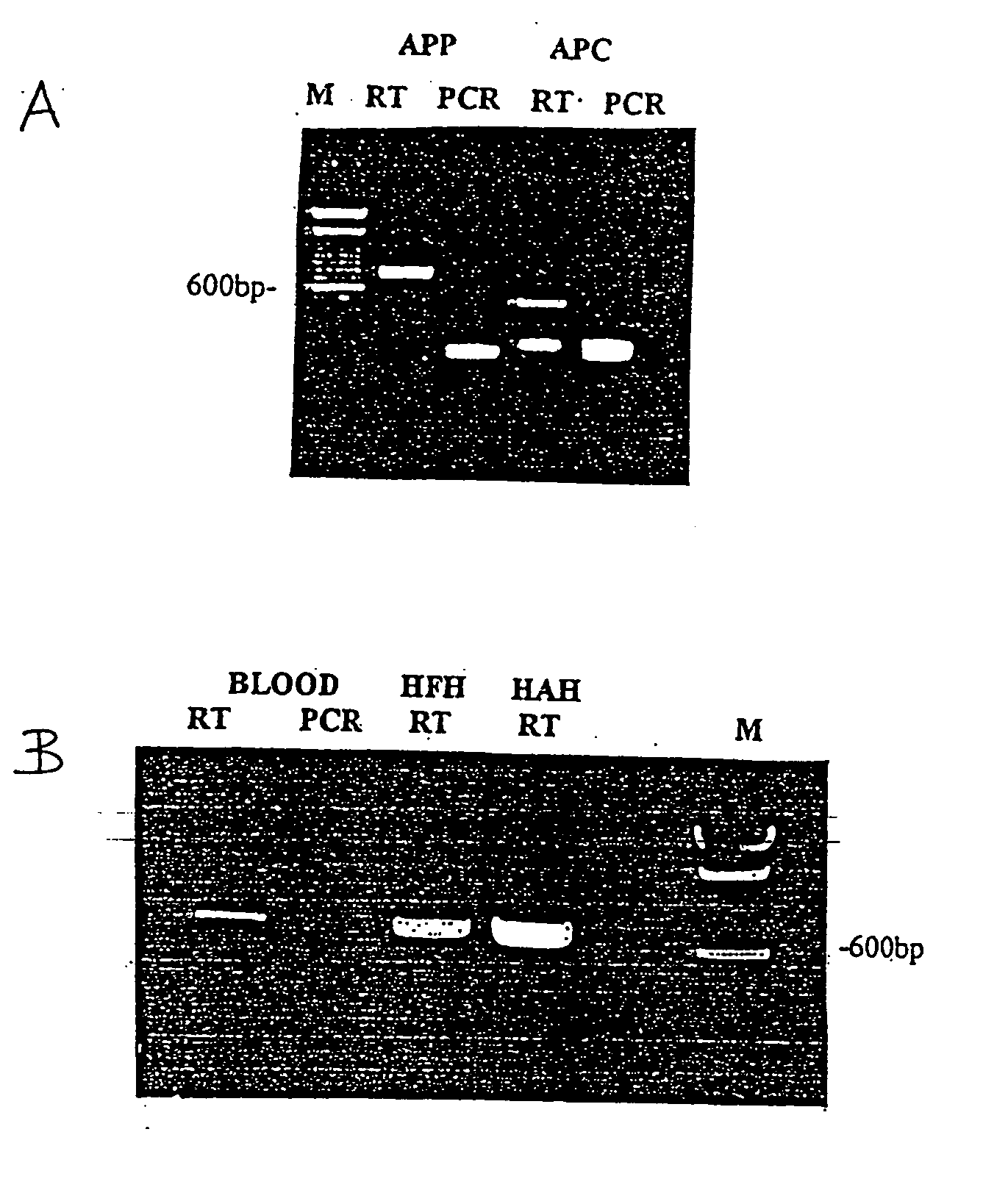 Method for the detection of coronary artery disease related gene transcripts in blood