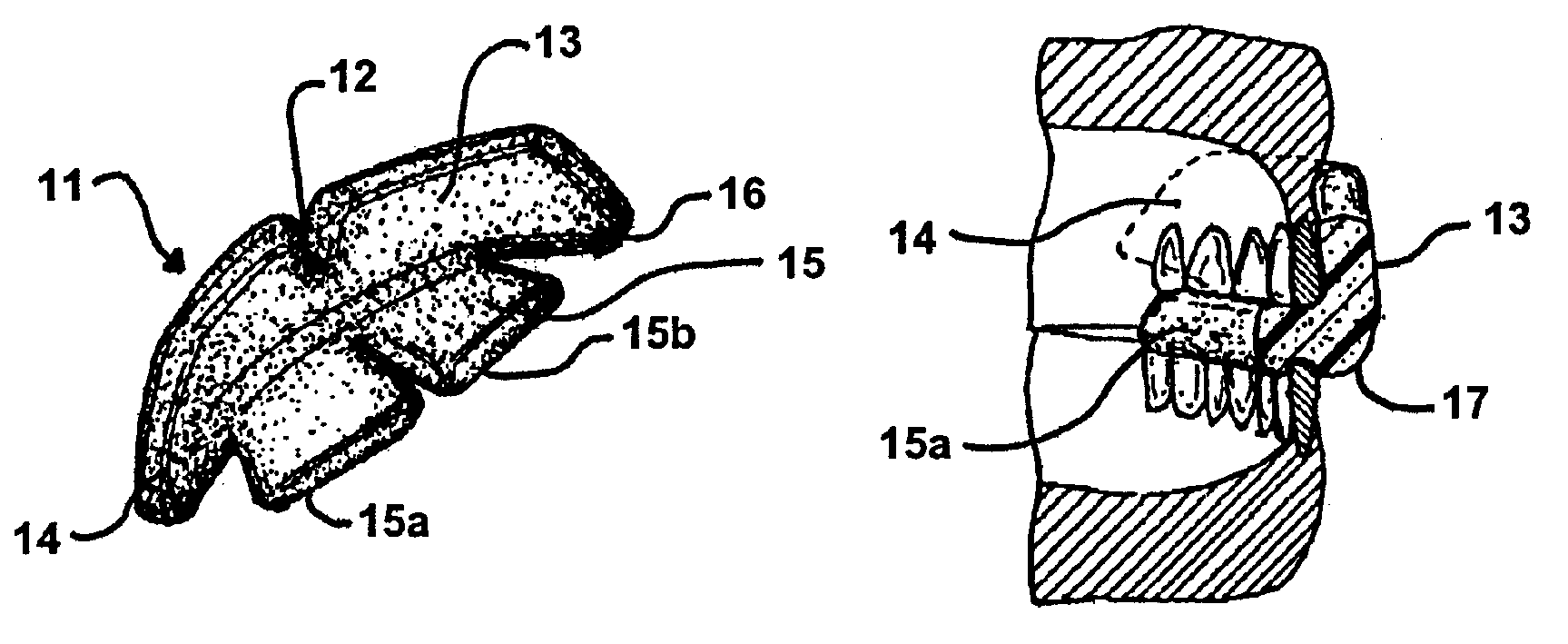 Molded foam mouthguard