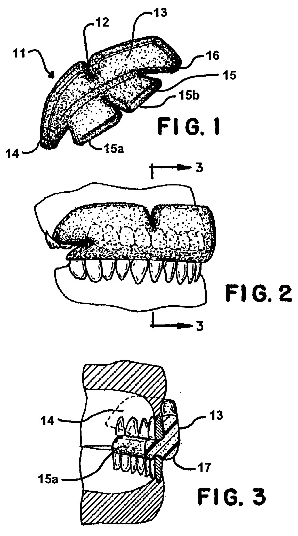 Molded foam mouthguard