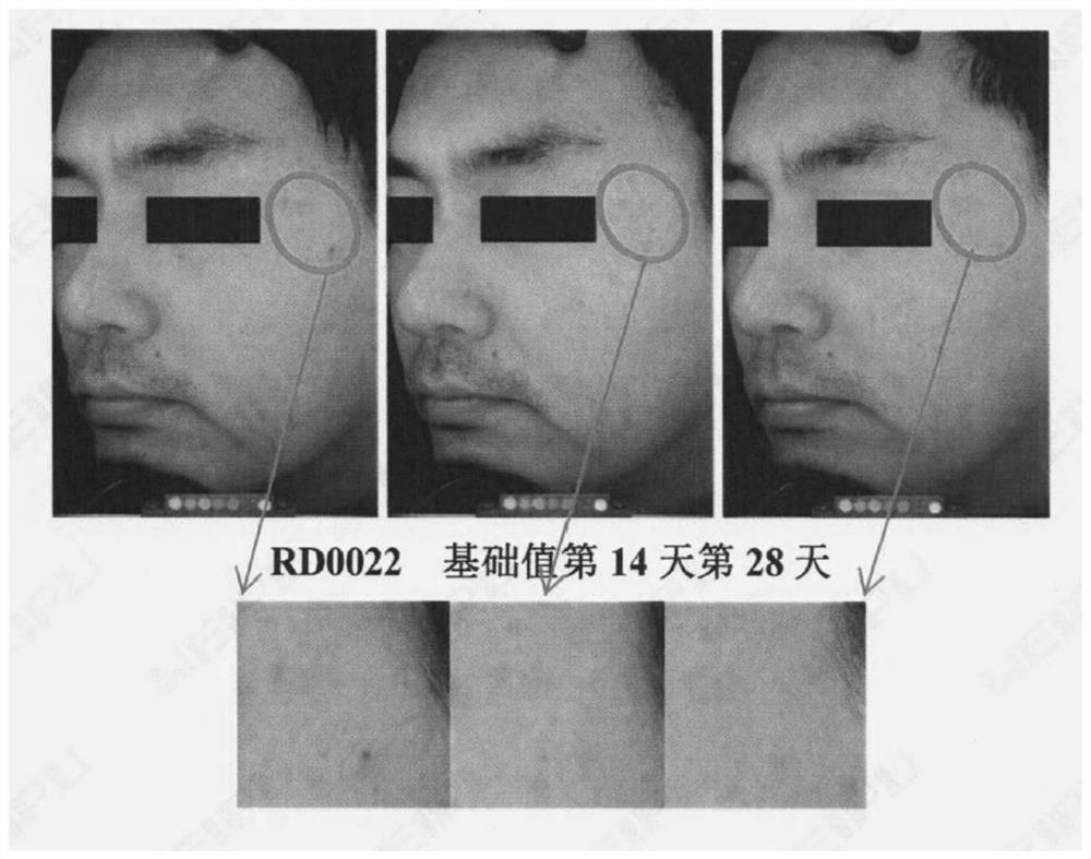 Acne removing composition and preparation method thereof