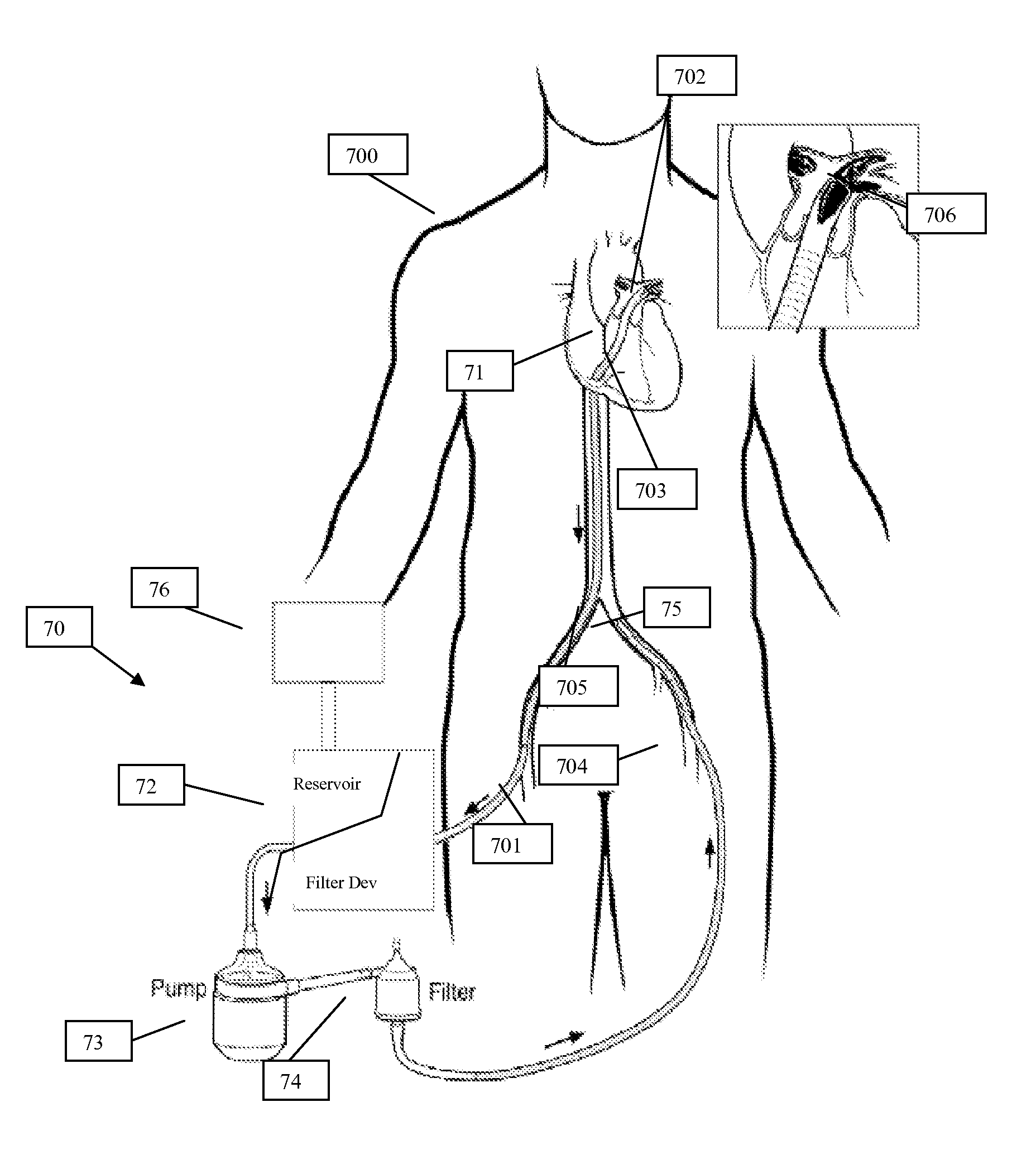 Systems and methods for removing undesirable material within a circulatory system utilizing a balloon catheter