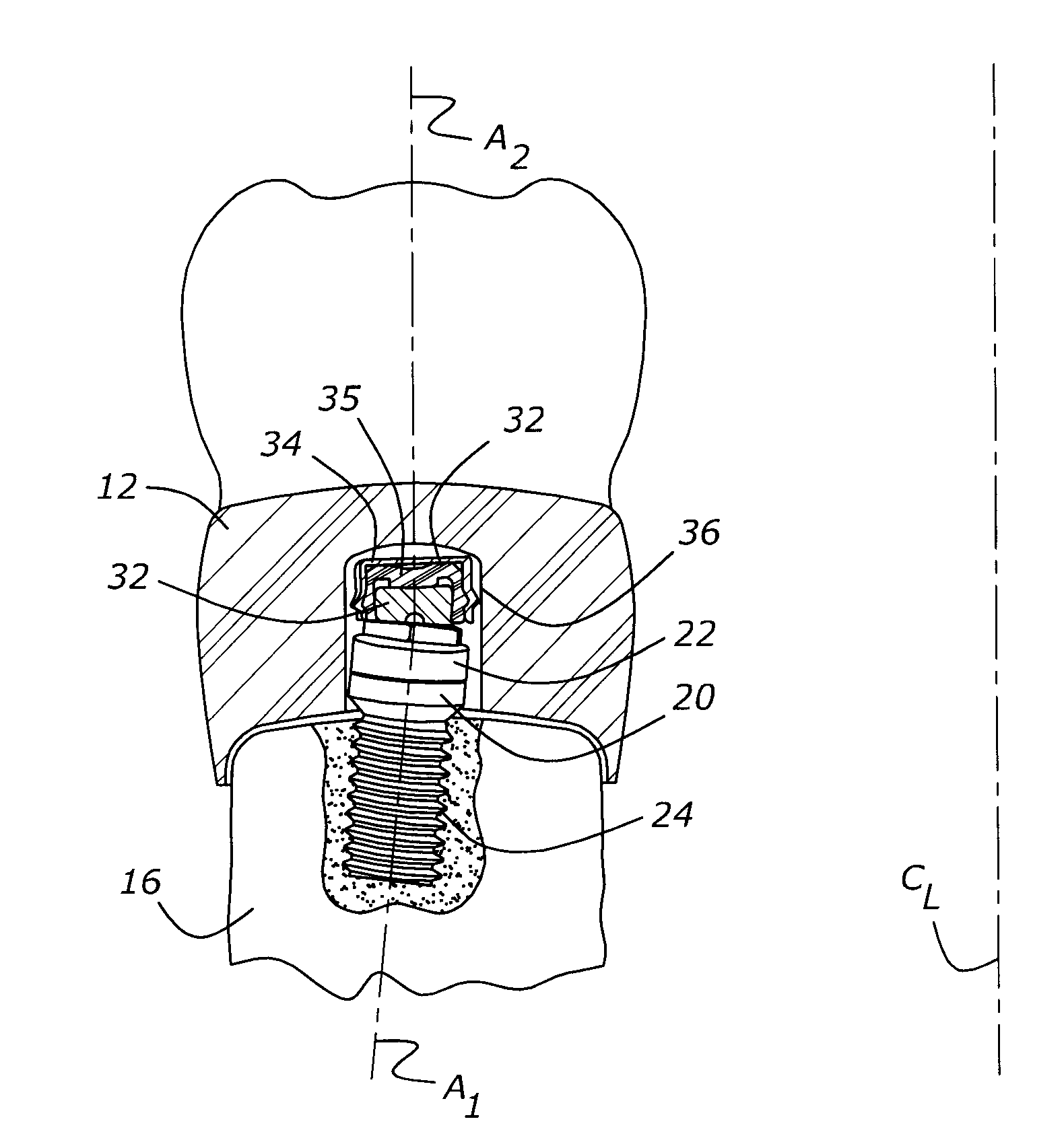 Method for fabricating an implanted dental restoration