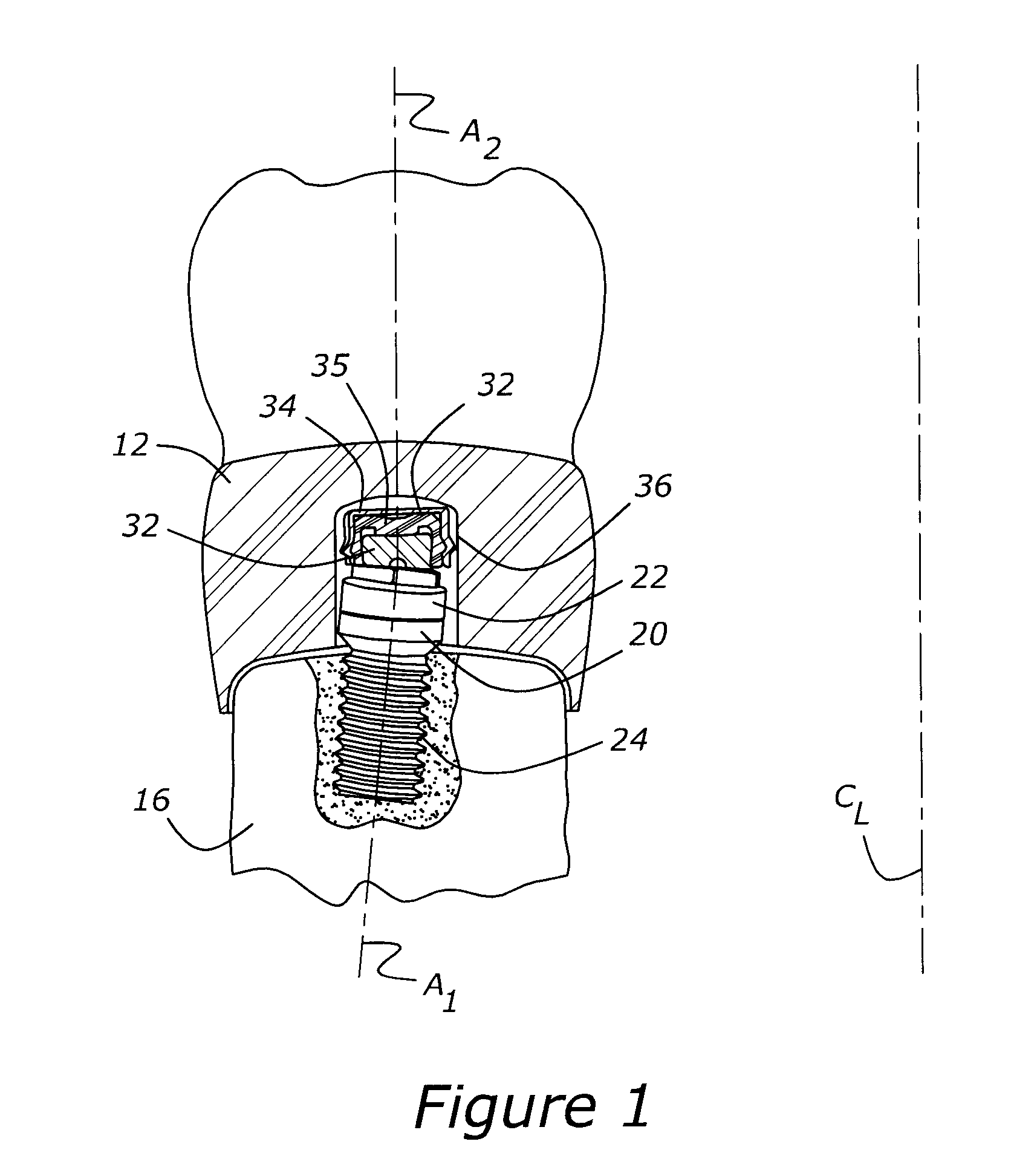 Method for fabricating an implanted dental restoration