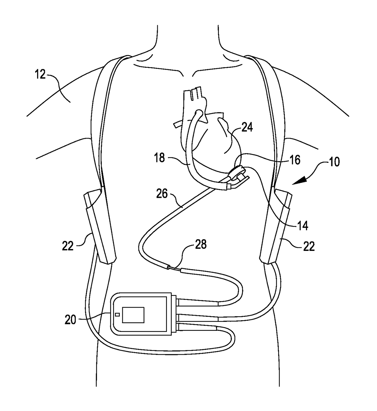 Methods and systems for providing battery feedback to patient