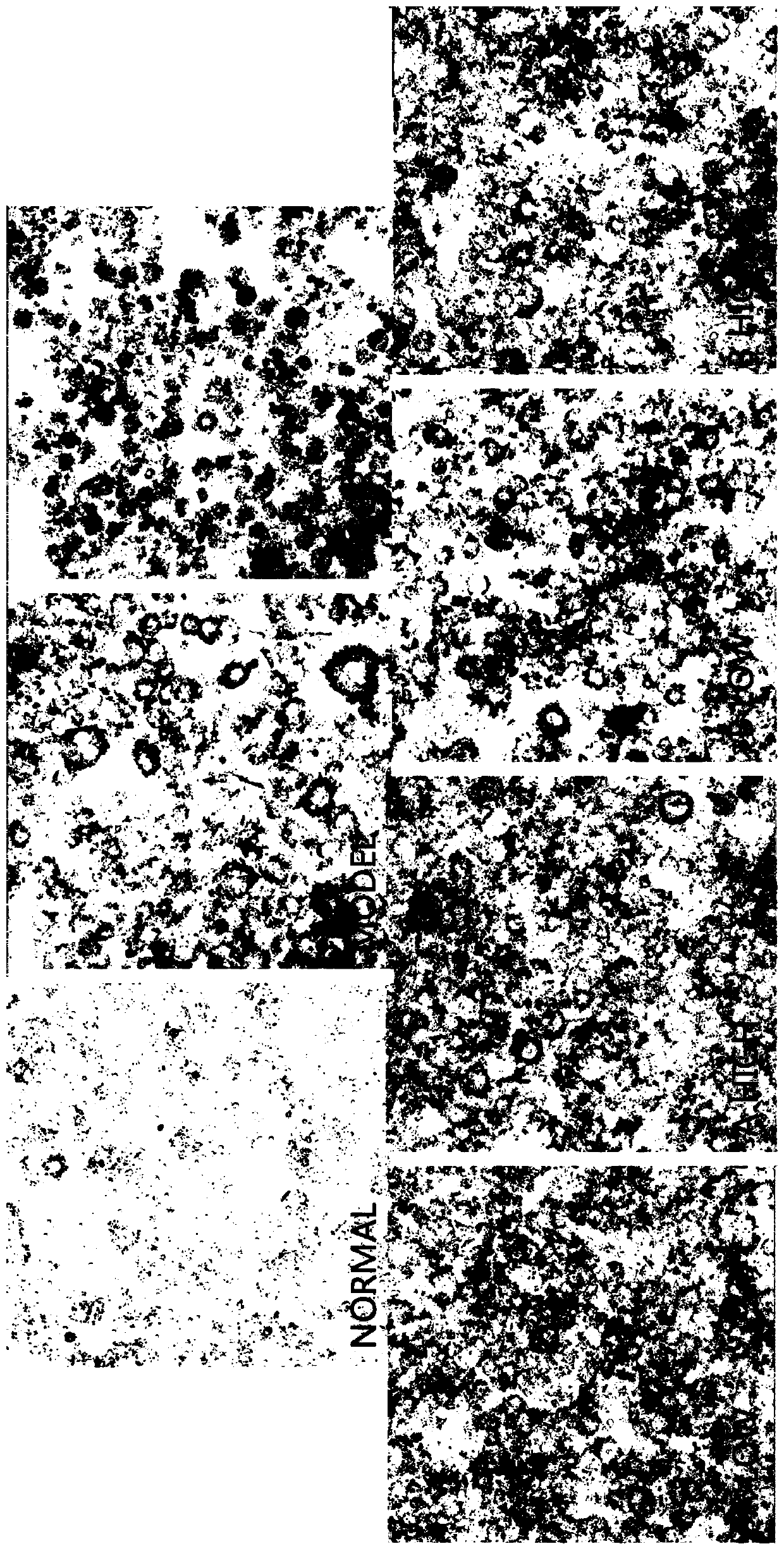 Application of sodium hydrogen sulfite andrographolide in preparation of promoter for promoting reverse transport of cholesterol