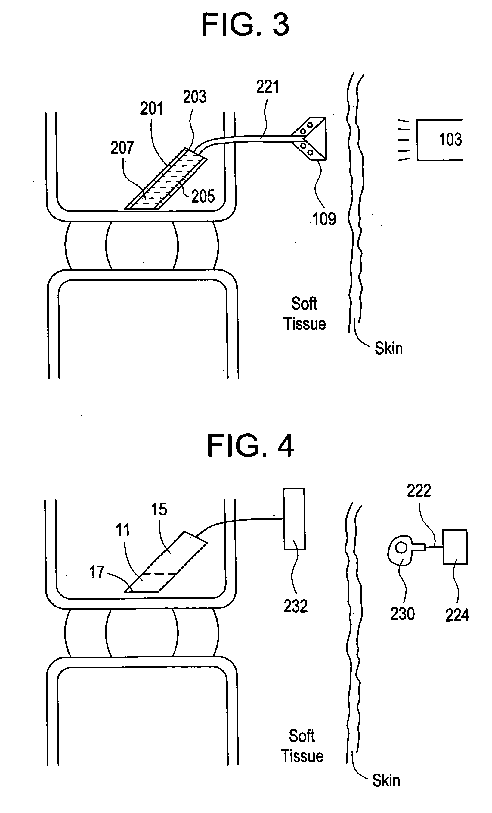 Red light implant for treating degenerative disc disease