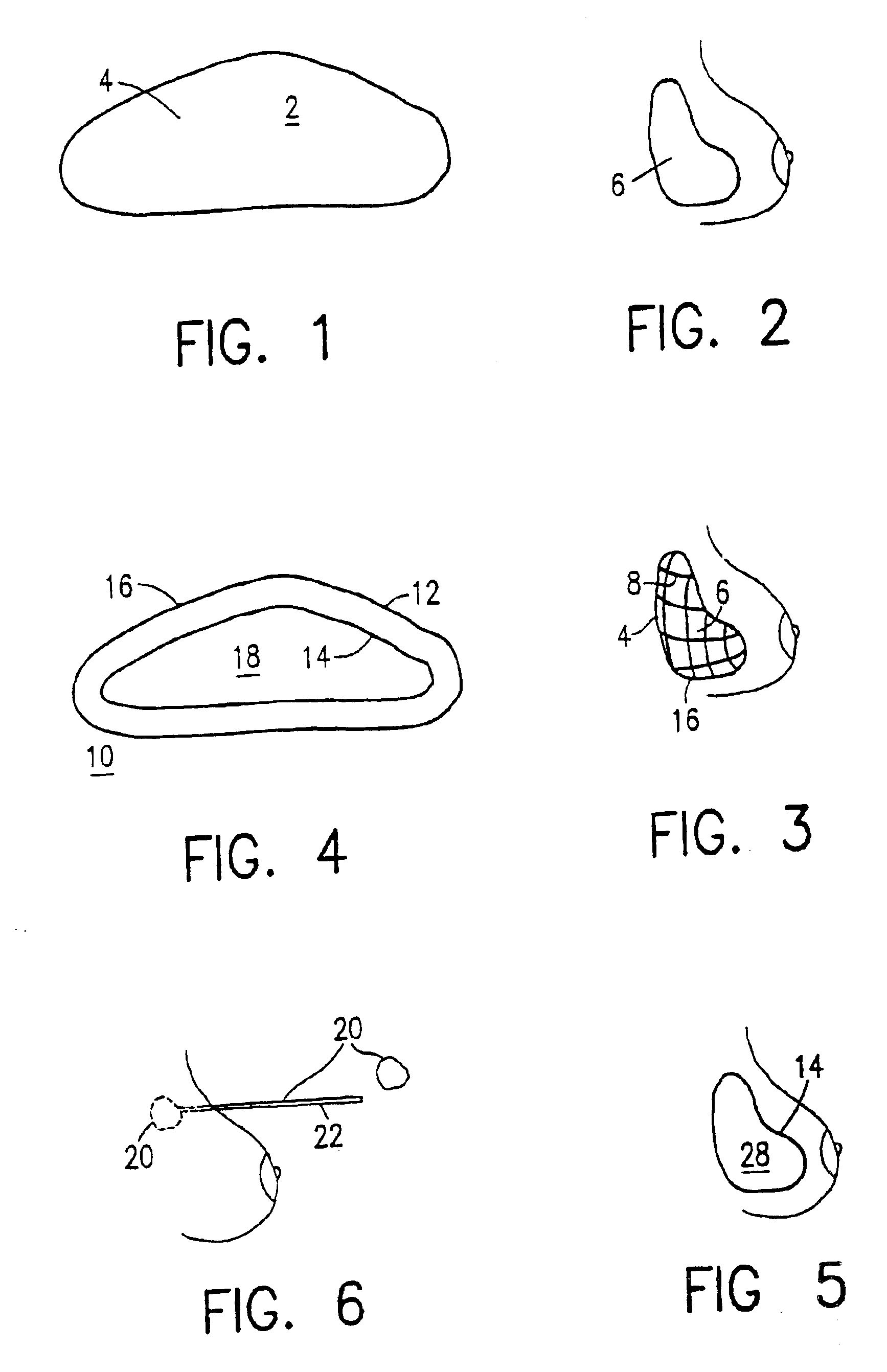 Bioabsorbable breast implant