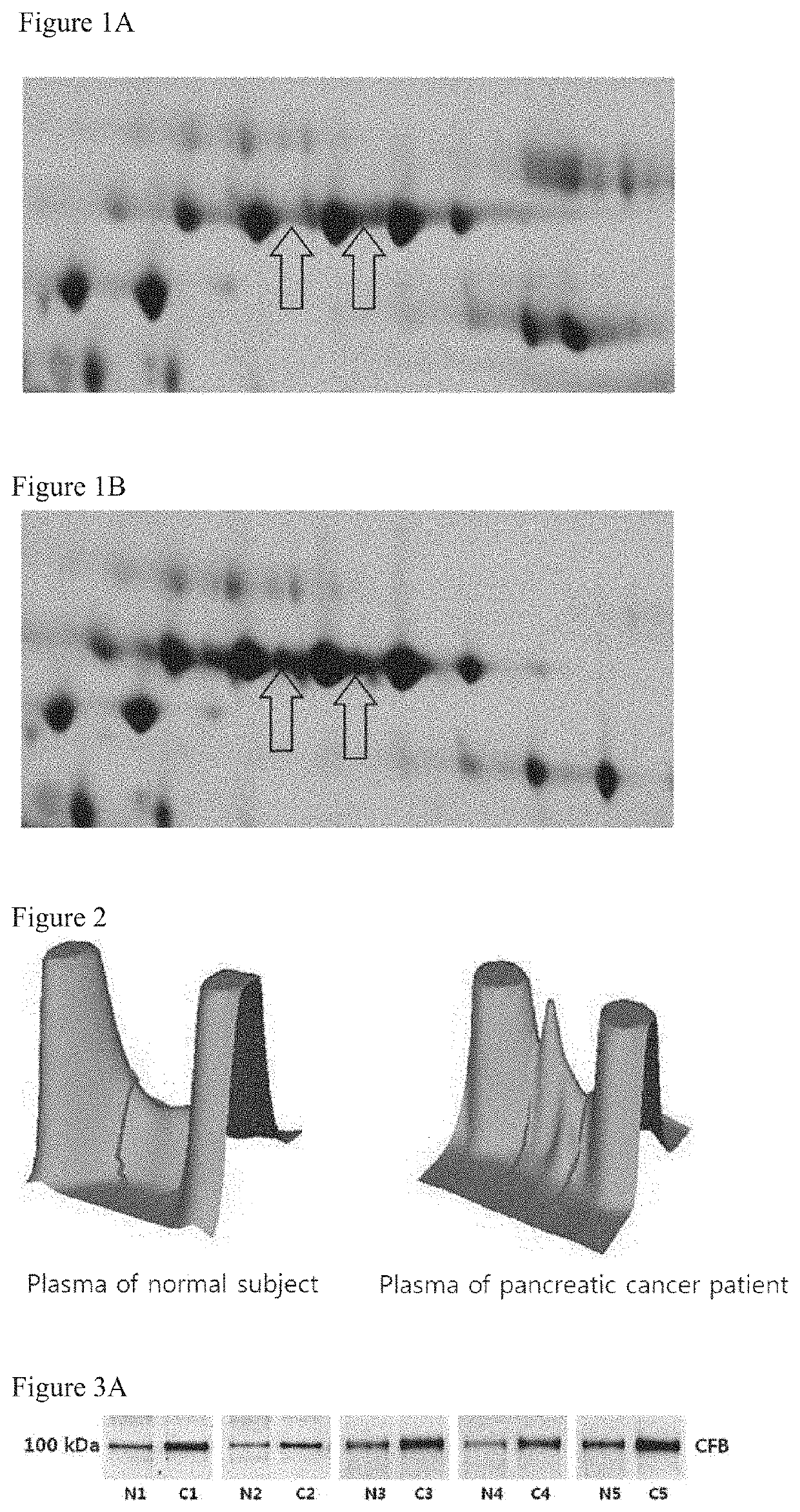 Methods for detecting an amount of complement factor B protein and carbohydrate antigen 19-9 protein, and methods for diagnosing and treating pancreatic cancer using the same