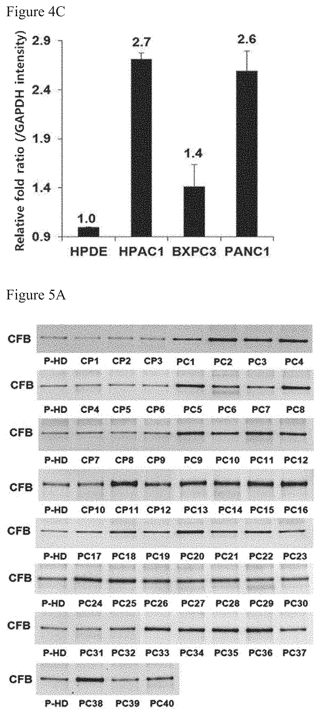 Methods for detecting an amount of complement factor B protein and carbohydrate antigen 19-9 protein, and methods for diagnosing and treating pancreatic cancer using the same