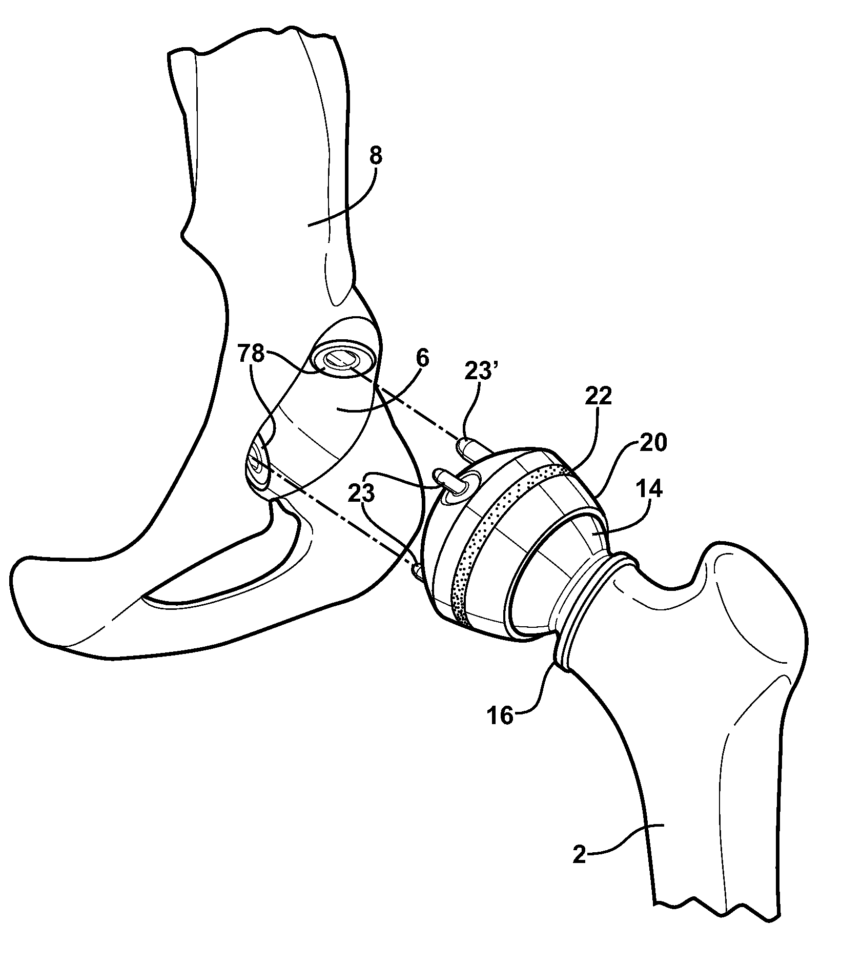 Combination male/female hip joint and installation kit