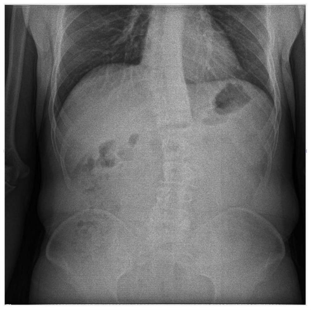 Noise reduction method and computer-readable storage medium for X-ray perspective image