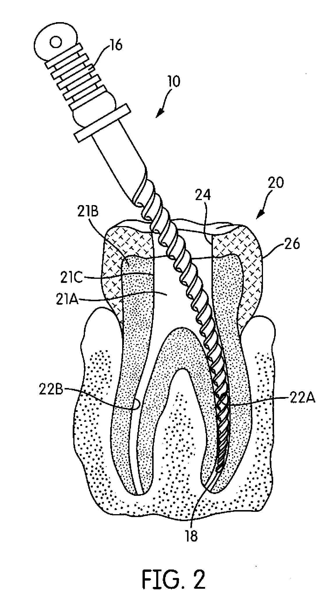 Endodontic instruments and methods of manufacturing thereof