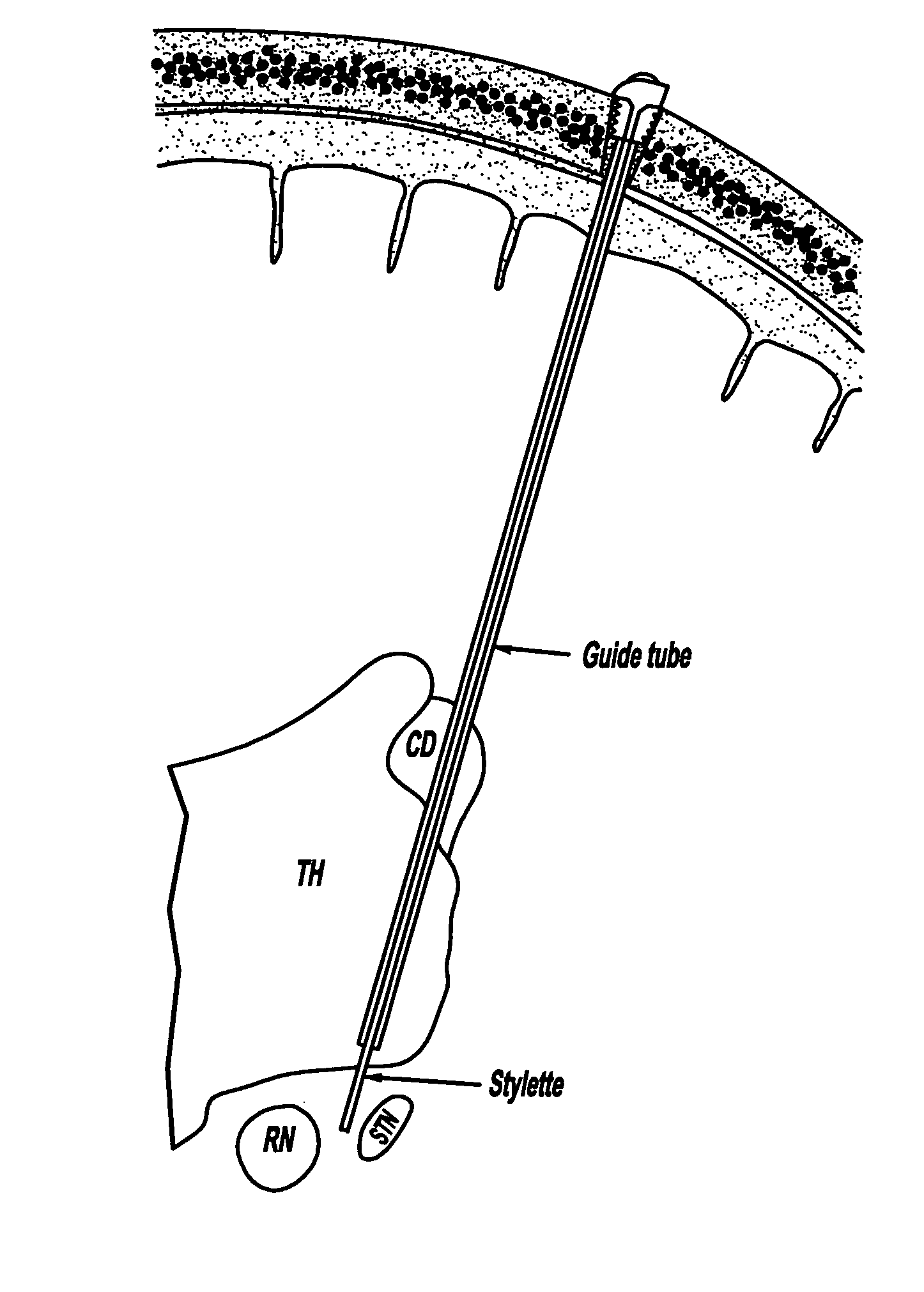 Deep brain stimulation