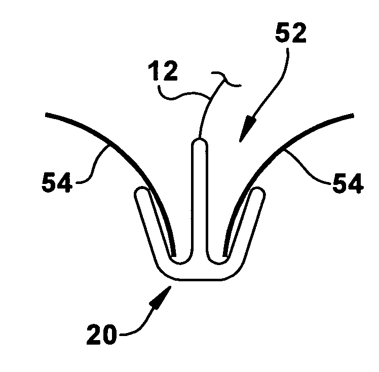 Apparatus and method for treating a regurgitant valve