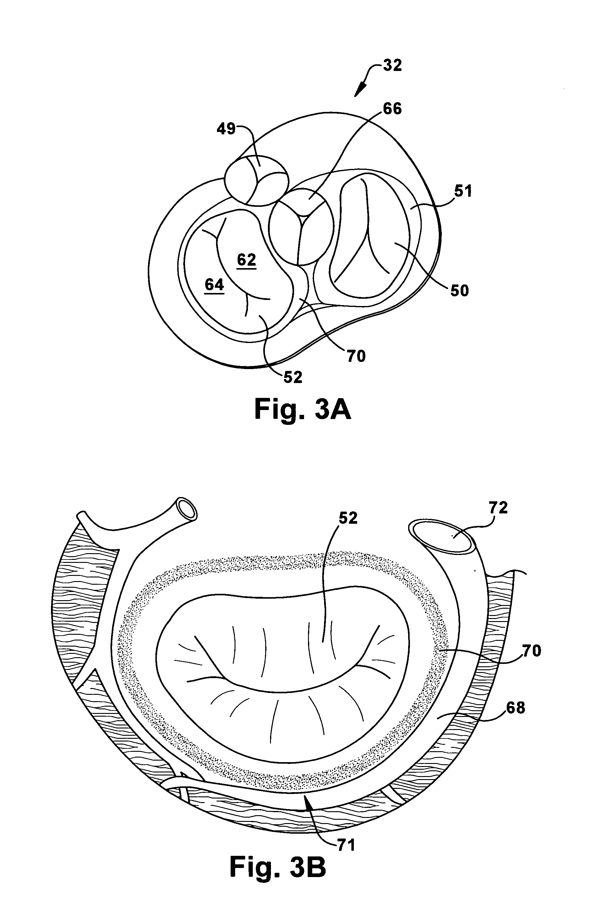 Apparatus and method for treating a regurgitant valve