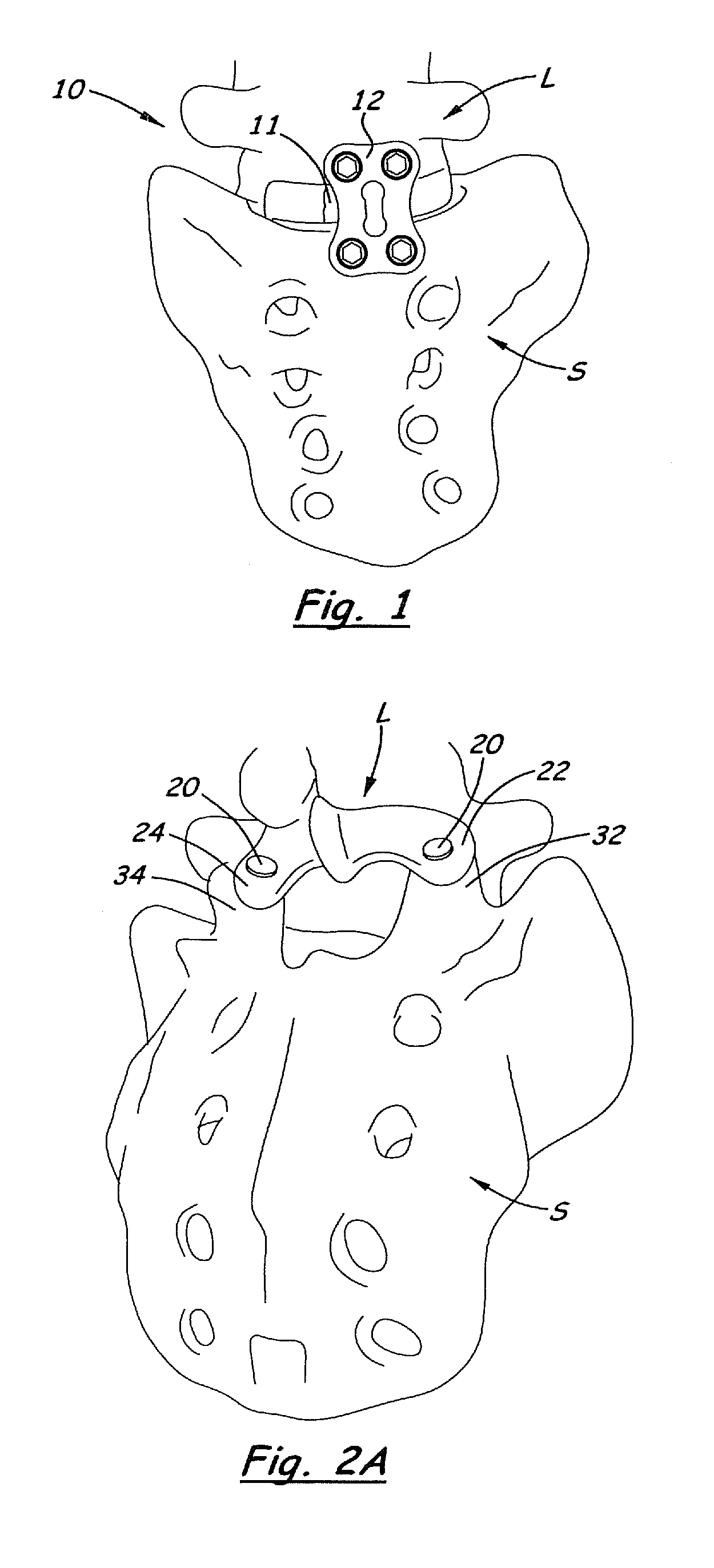 Tack for spine fixation