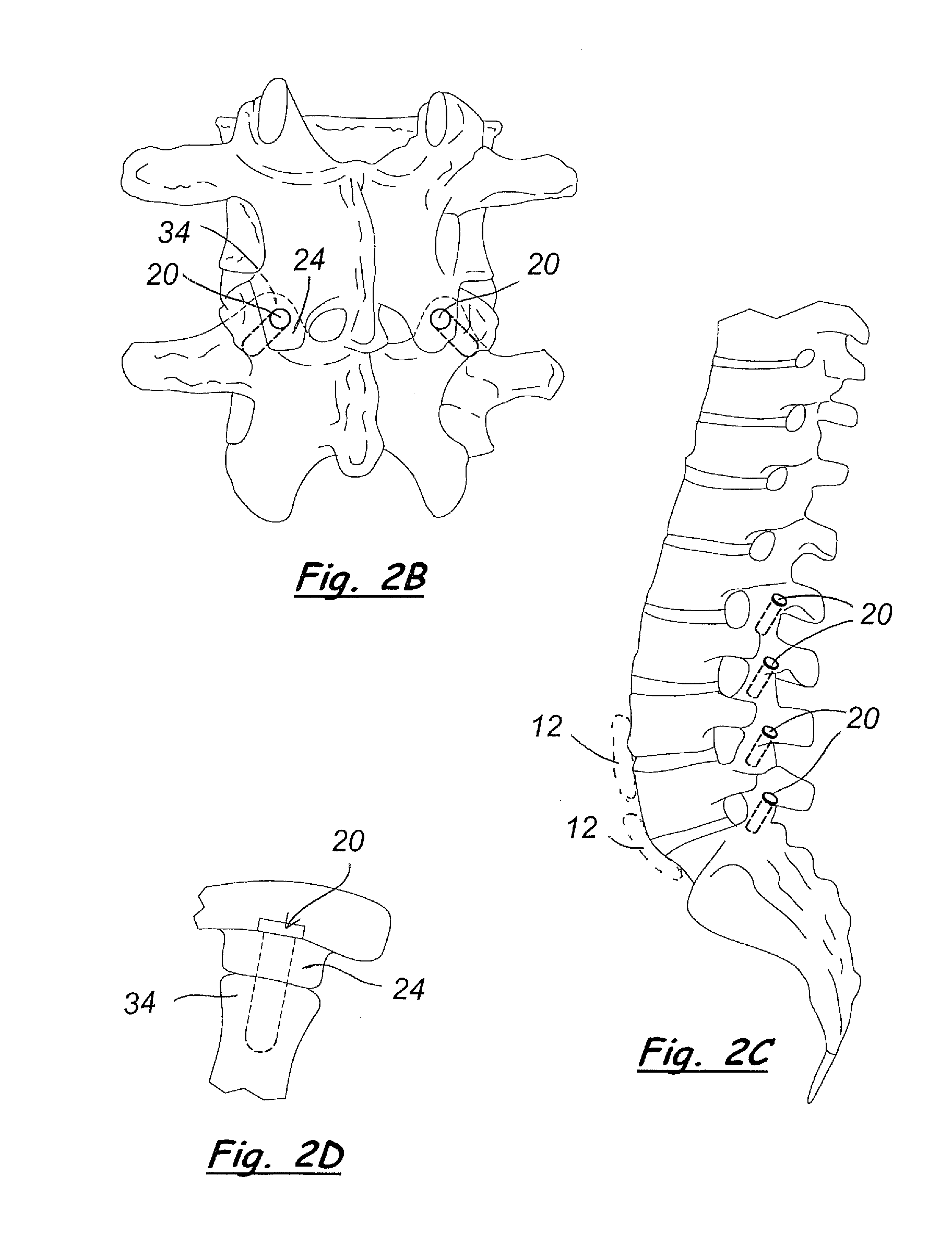 Tack for spine fixation