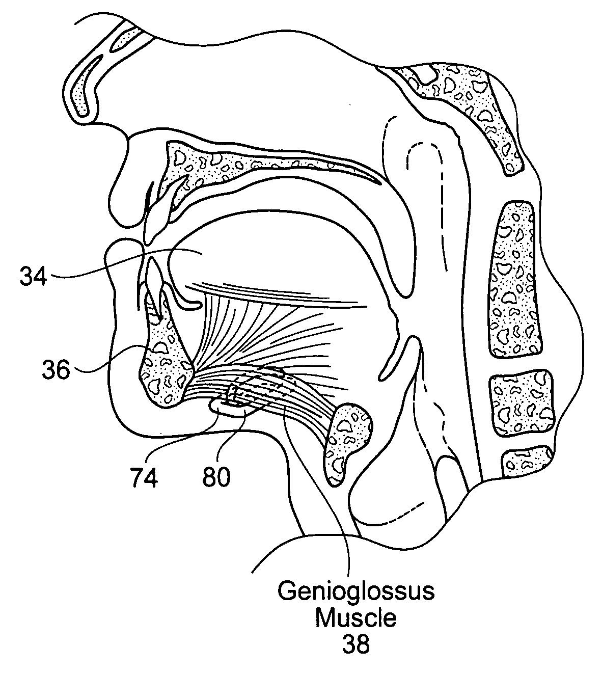 Implantable devices, systems, and methods for maintaining desired orientations in targeted tissue regions