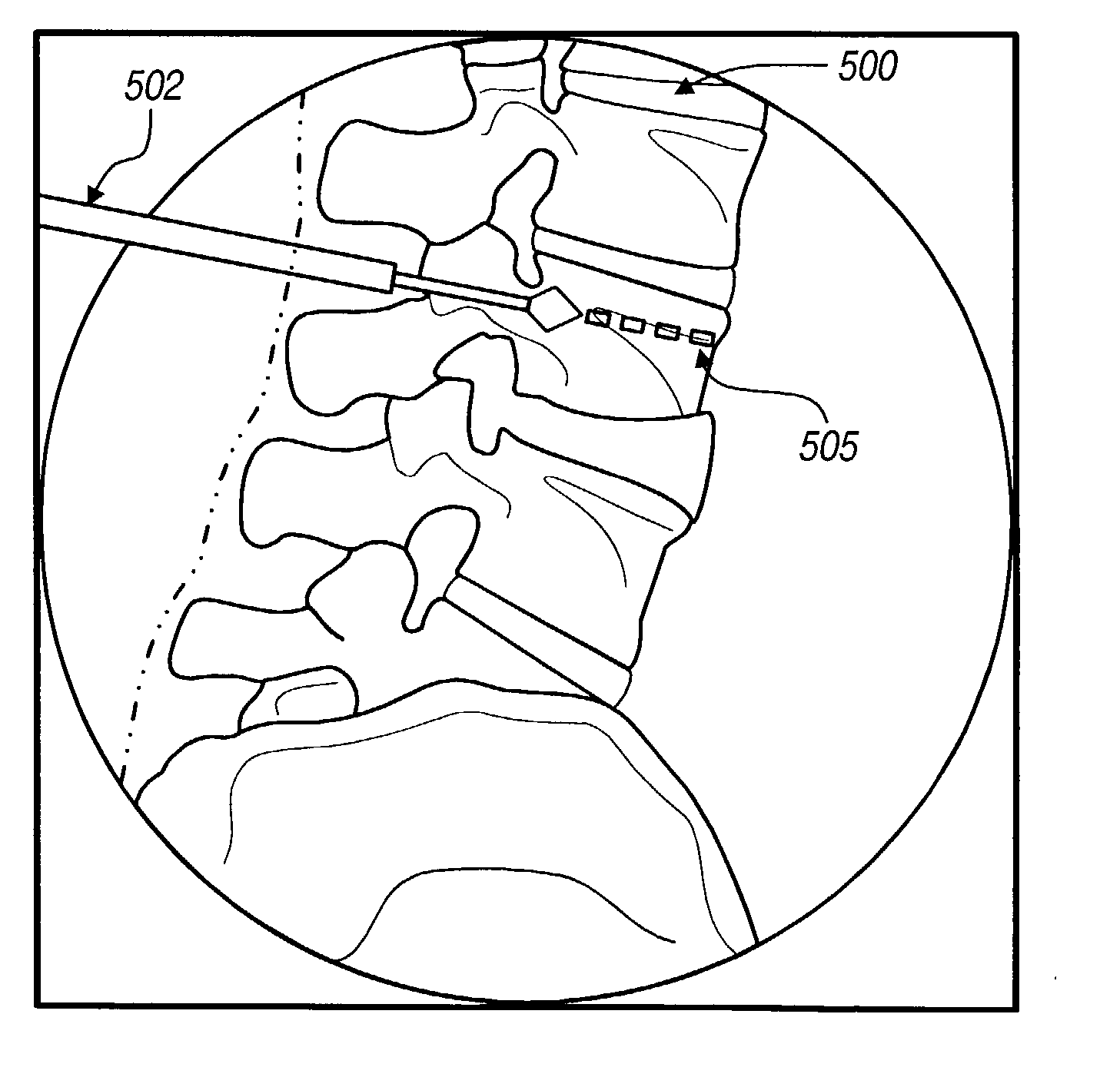 Navigational guidance via computer-assisted fluoroscopic imaging