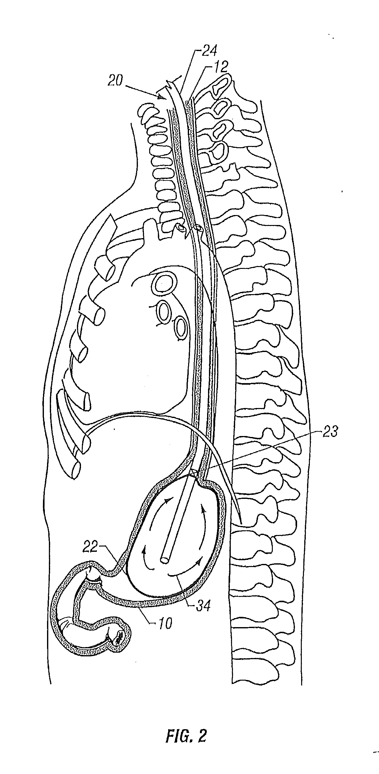 Apparatus and method for esophageal cooling