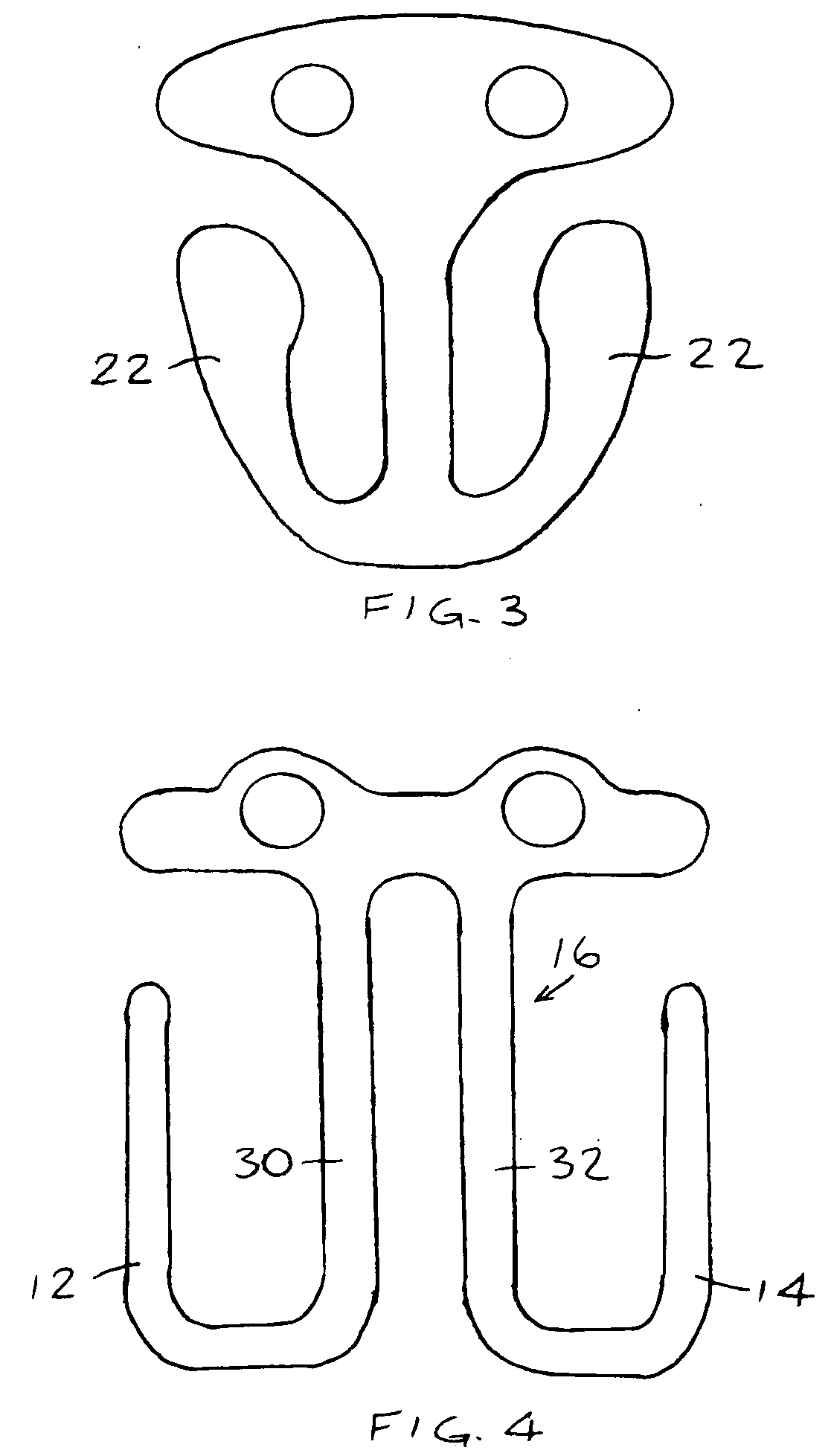 Intraocular clip