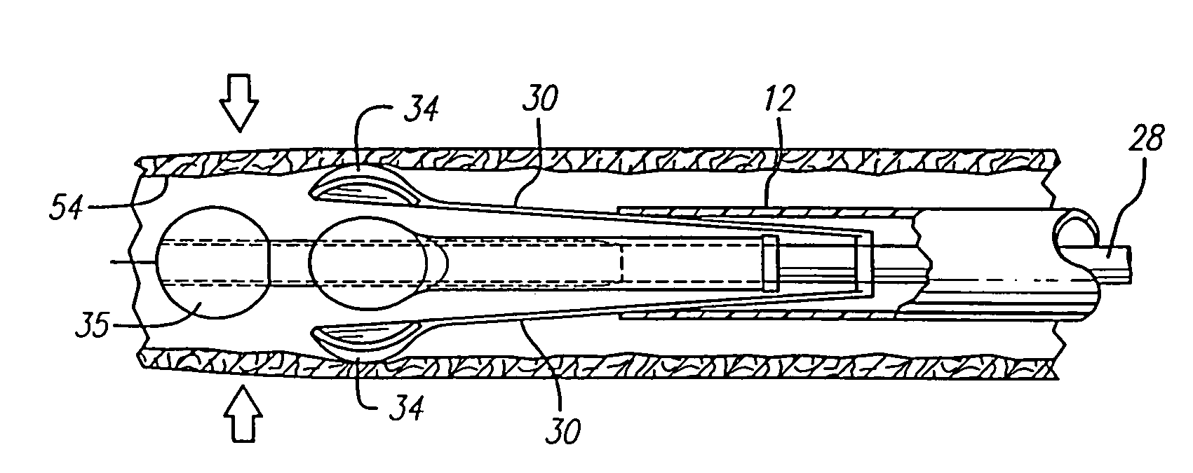 Method of using expandable vein ligator catheter having multiple electrode leads