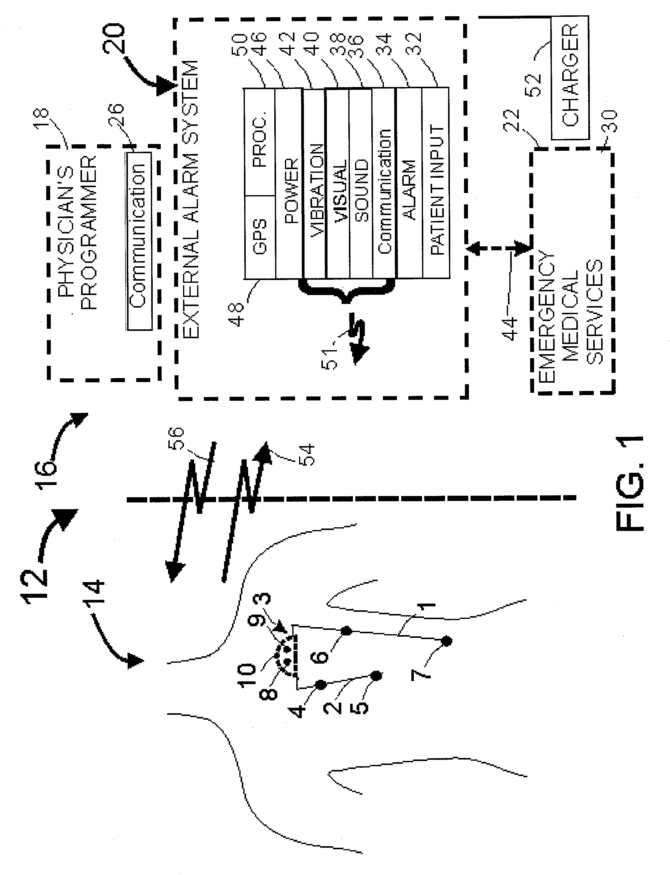 Ischemia monitoring system for patients having periods of left bundle branch block