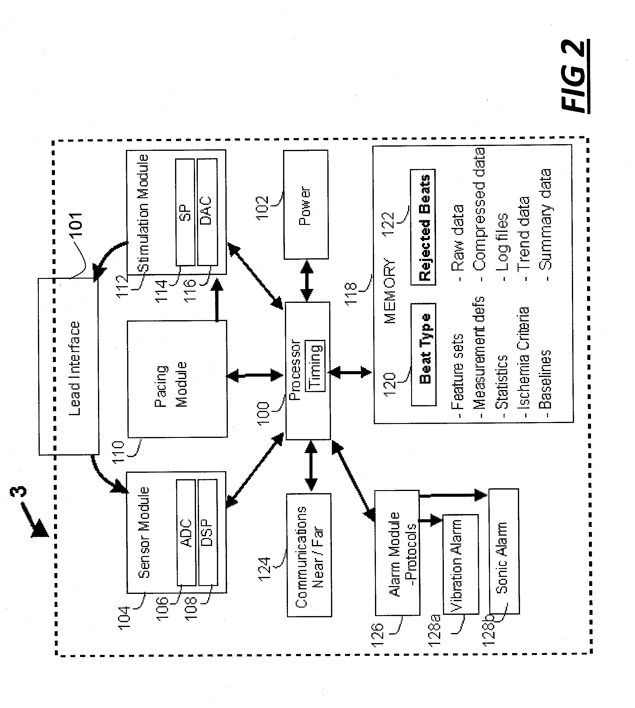 Ischemia monitoring system for patients having periods of left bundle branch block