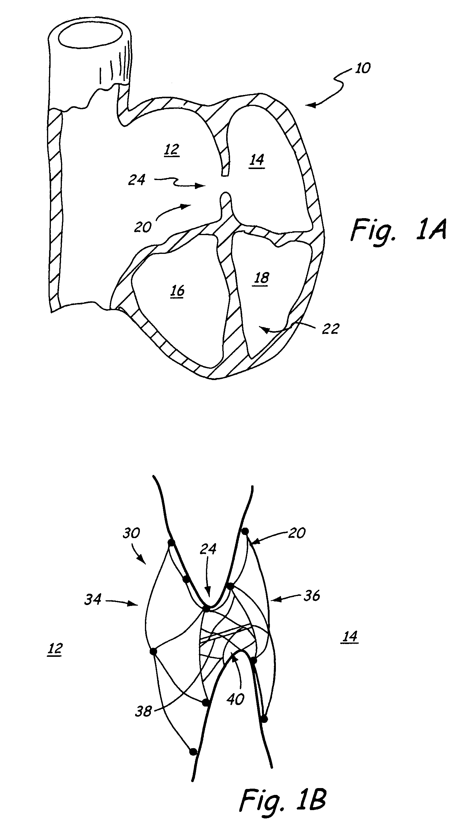 Self centering closure device for septal occlusion