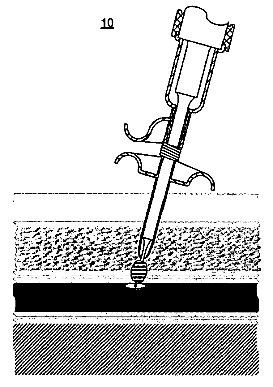 Ultrasonic vascular closure method