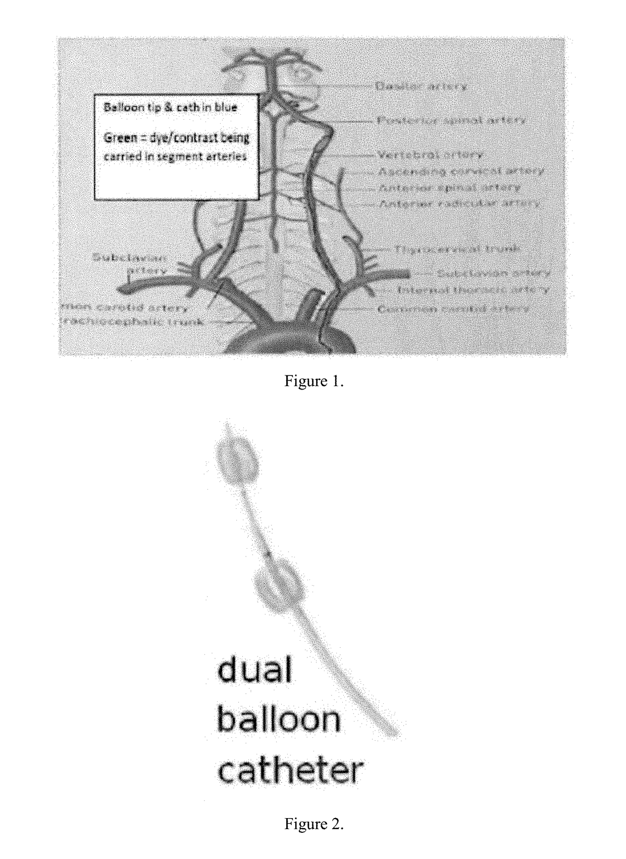 Novel non-invasive method for direct delivery of therapeutics to the spinal cord in the treatment of spinal cord pathology