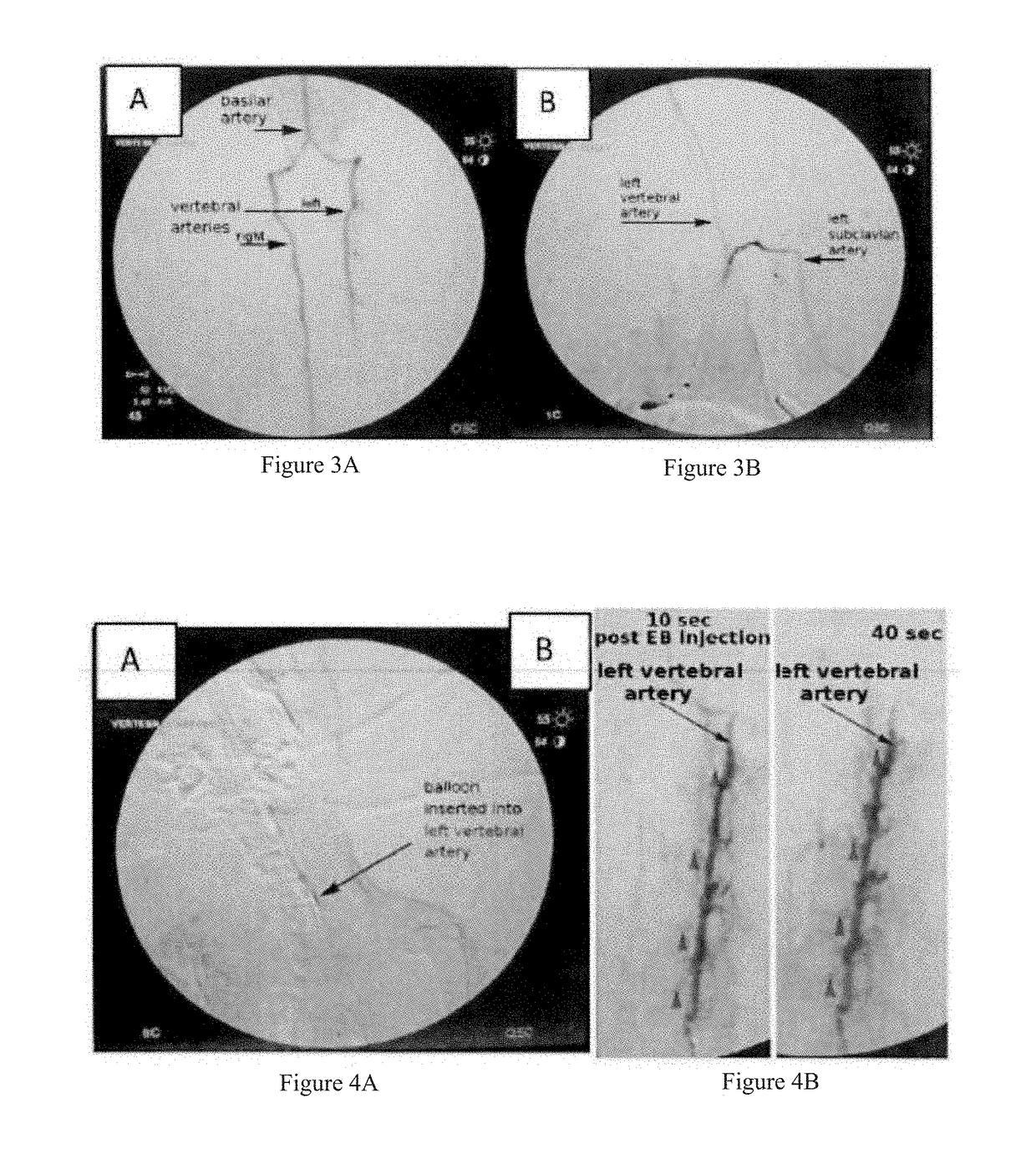 Novel non-invasive method for direct delivery of therapeutics to the spinal cord in the treatment of spinal cord pathology