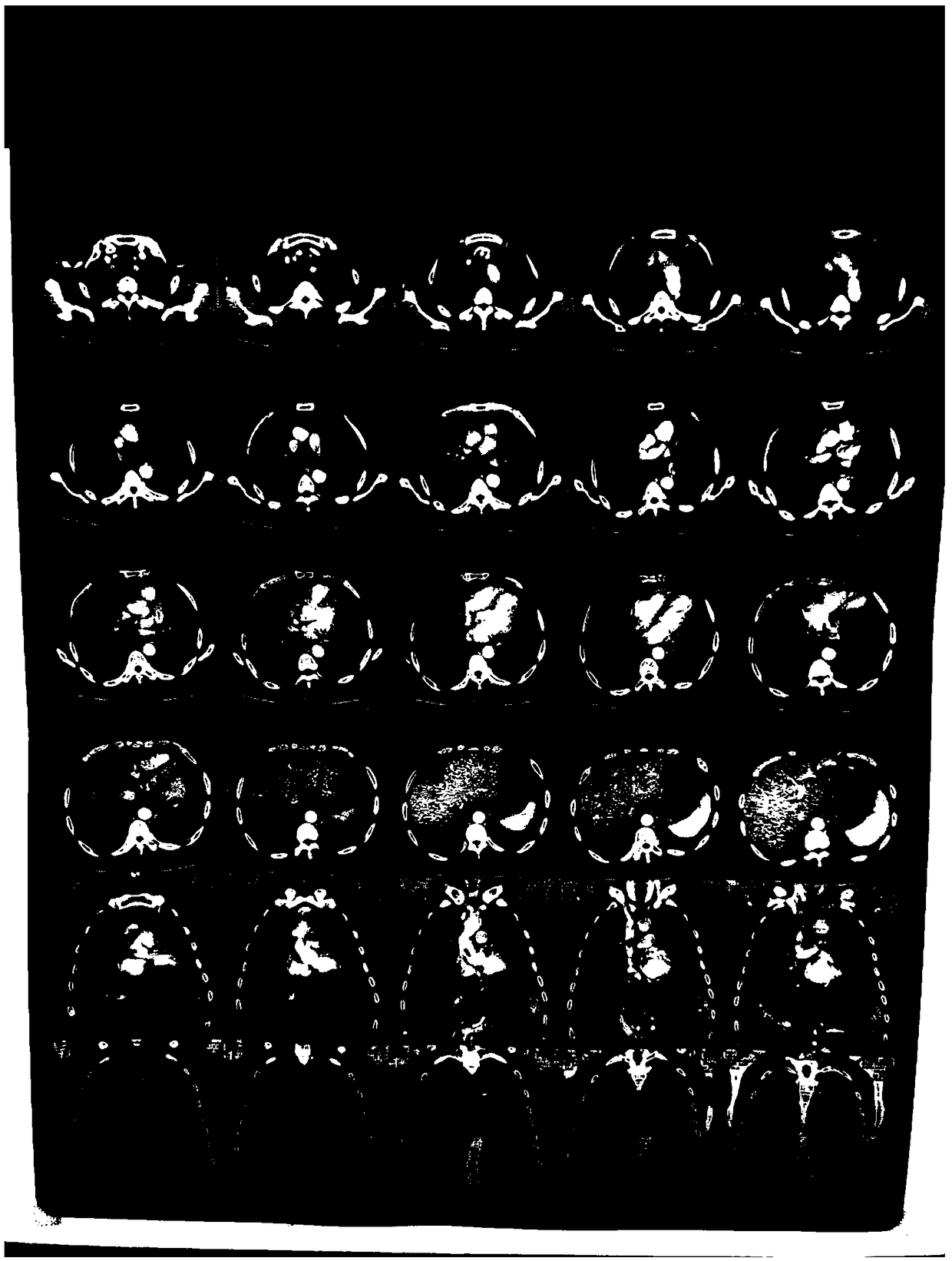 Lung cancer treatment medicine and preparation method and application thereof