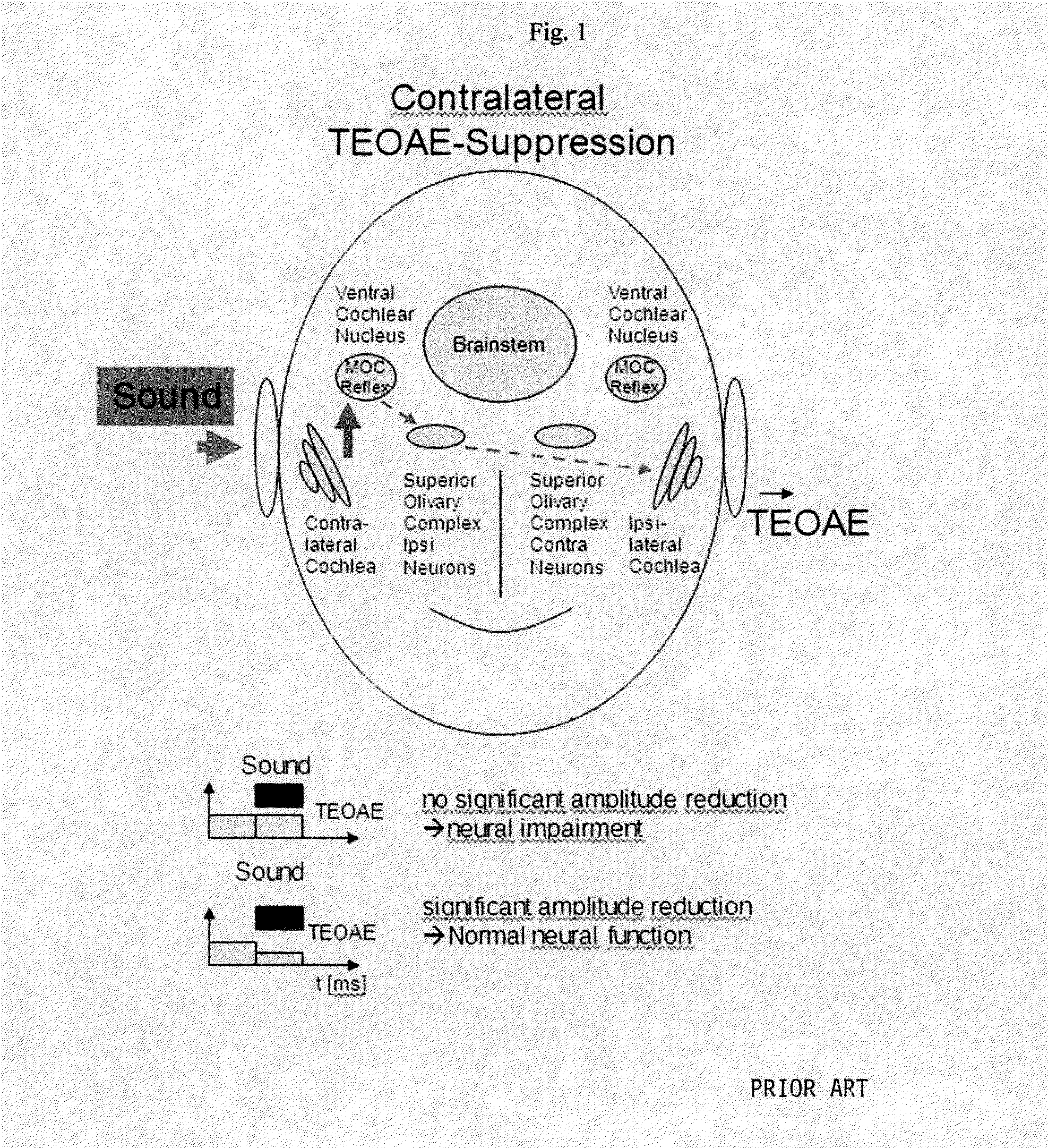 Method and Apparatus for Automated Detection of Suppression of TEOAE by Contralateral Acoustic Stimulation