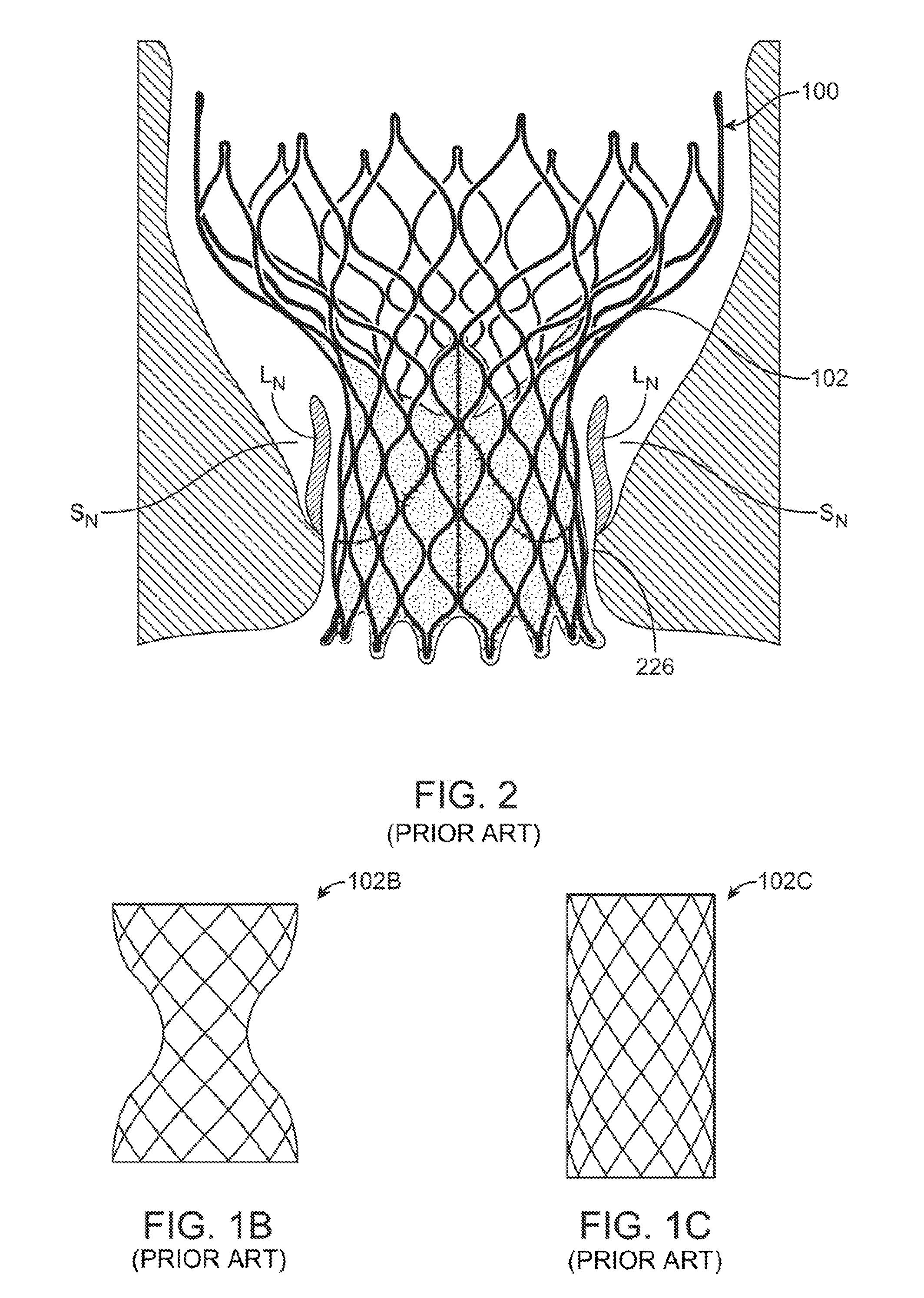 Anti-paravalvular leakage component for a transcatheter valve prosthesis