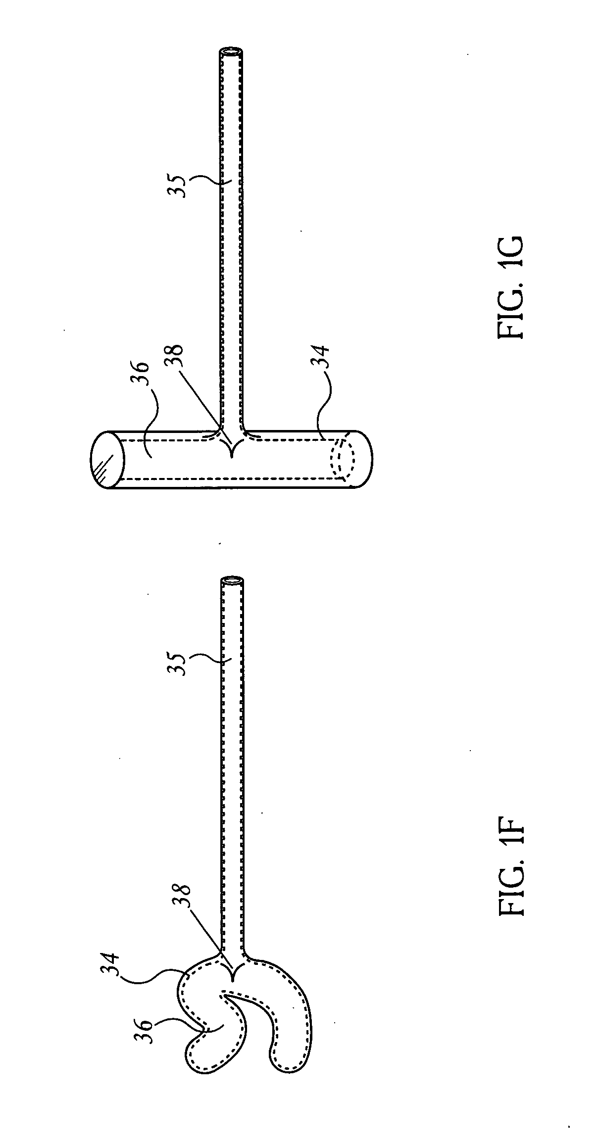 Extragastric devices and methods for gastroplasty