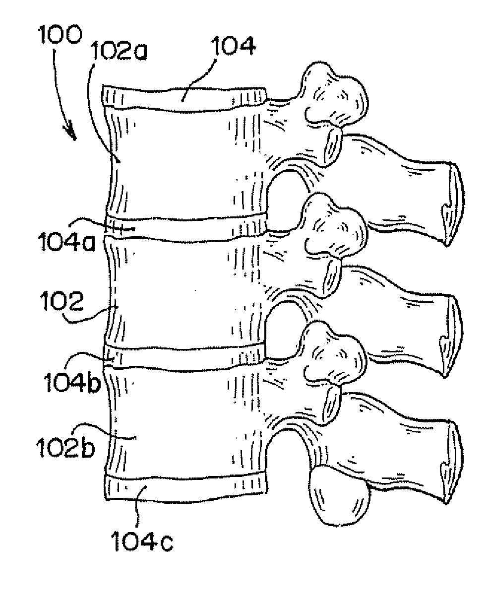 Methods for Limiting the Movement of Material Introduced Between Layers of Spinal Tissue