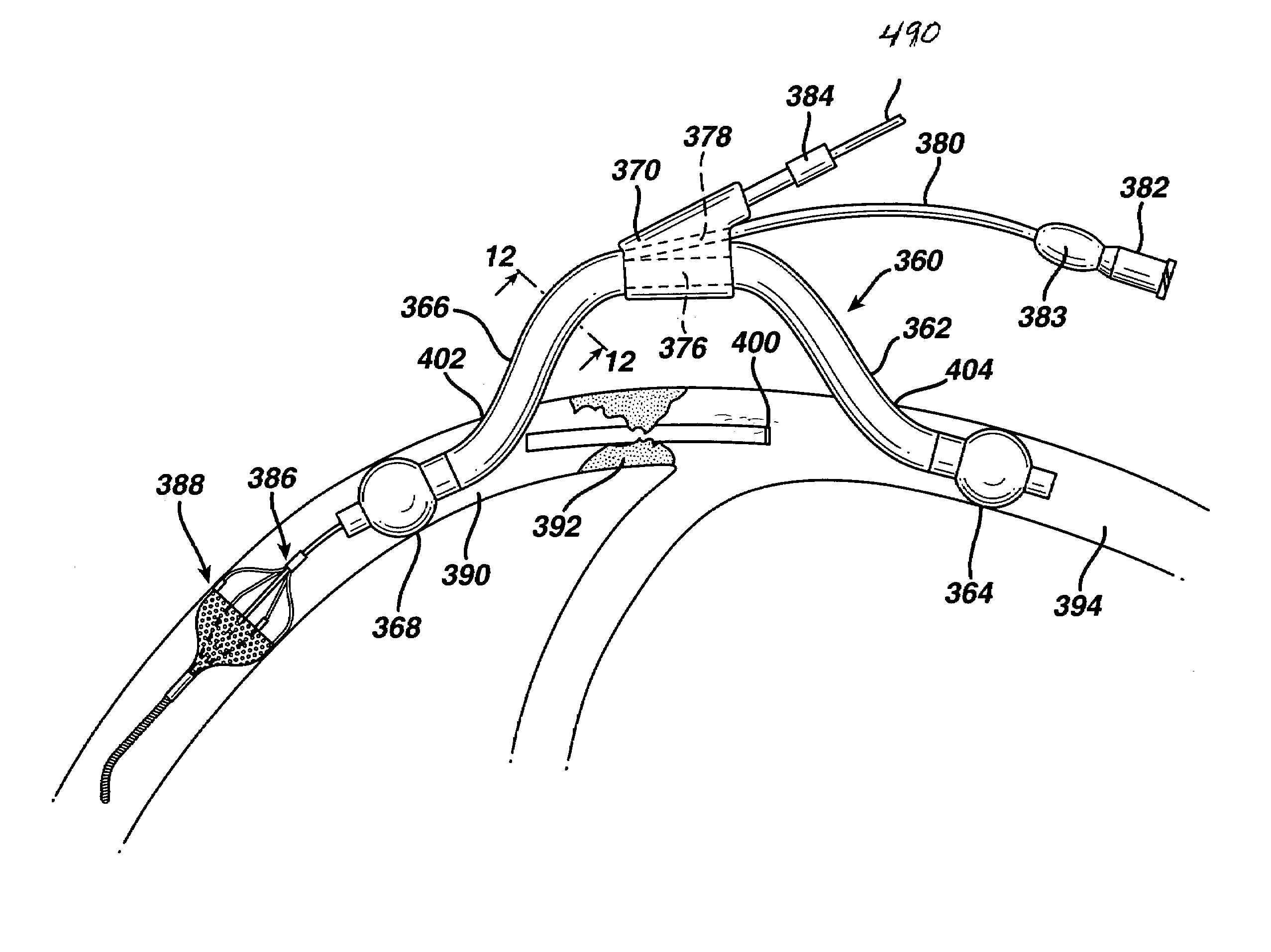 Vascular filter system for carotid endarterectomy