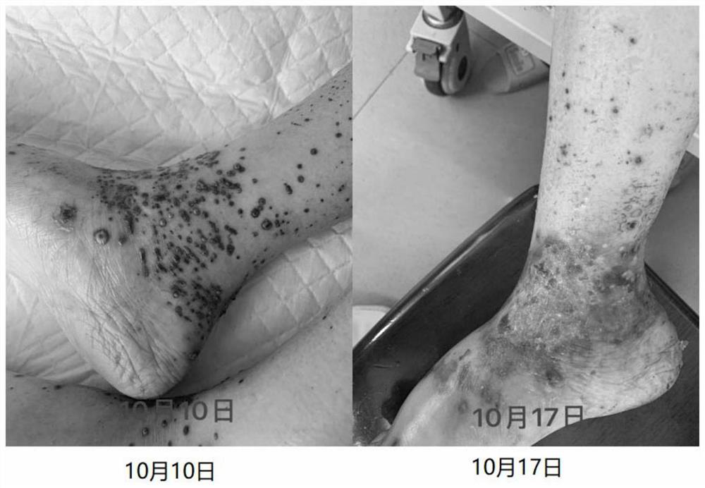 Traditional Chinese medicine mask for treating rash related with molecular targeted anti-tumor drugs and preparation method thereof