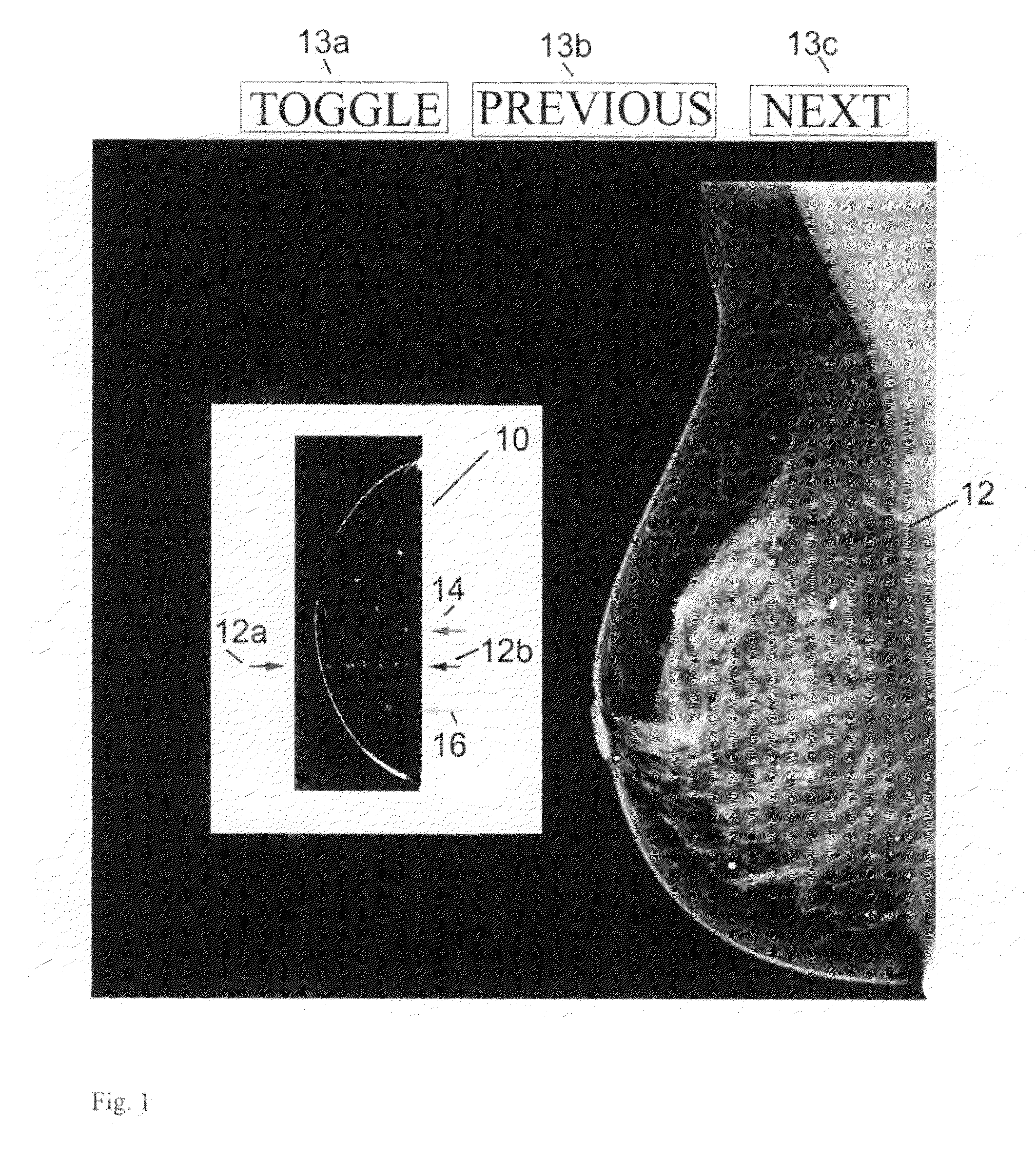 Breast tomosynthesis with display of highlighted suspected calcifications