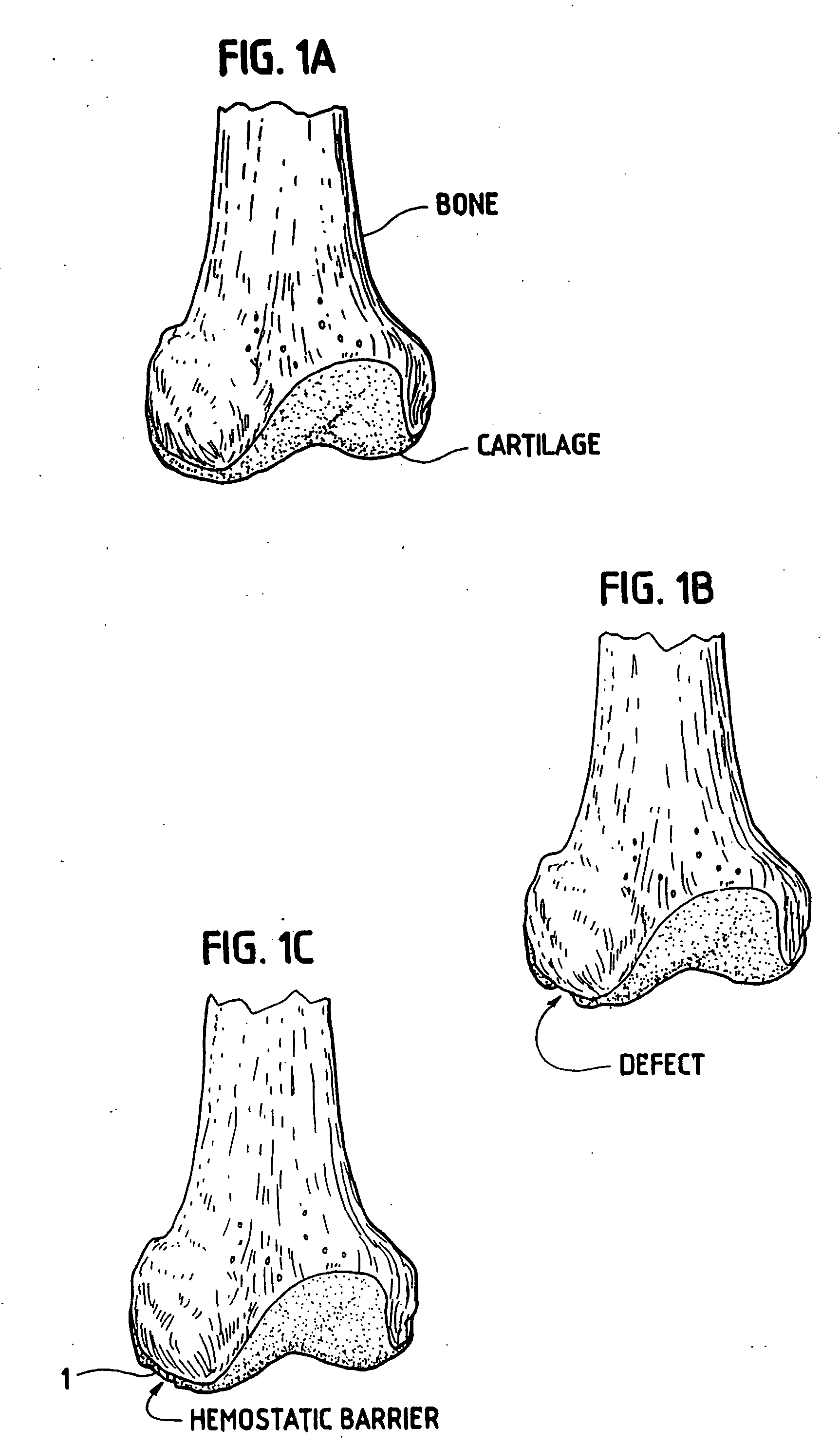 Method, instruments, and kit for autologous transplantation