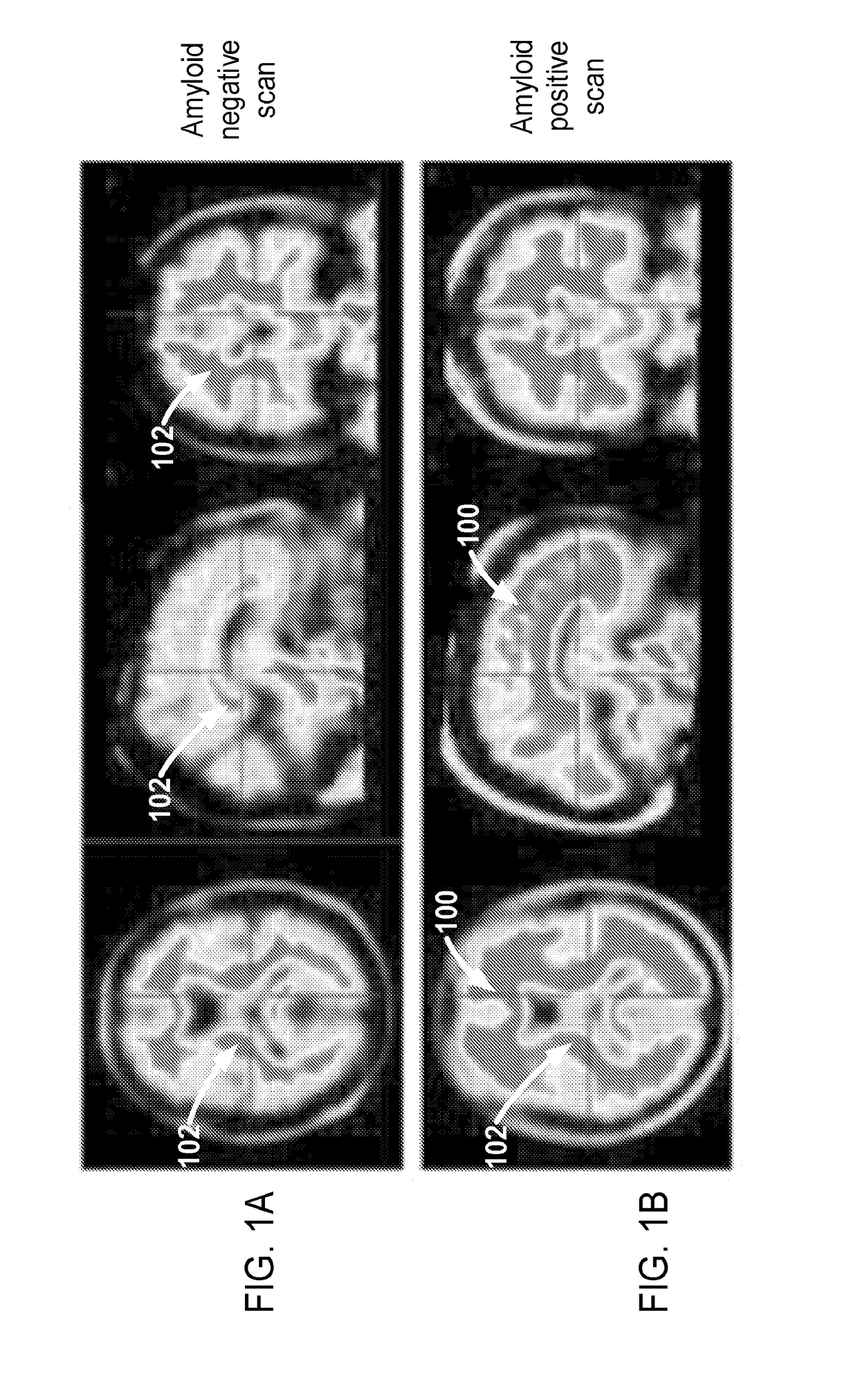 Determining a brain condition using early time frame pet image analysis