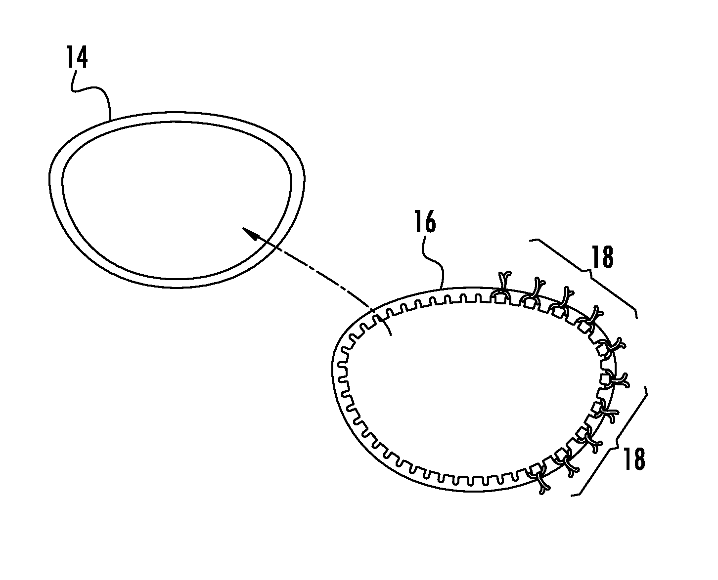 Prosthetic device for heart valve reinforcement and remodeling procedures