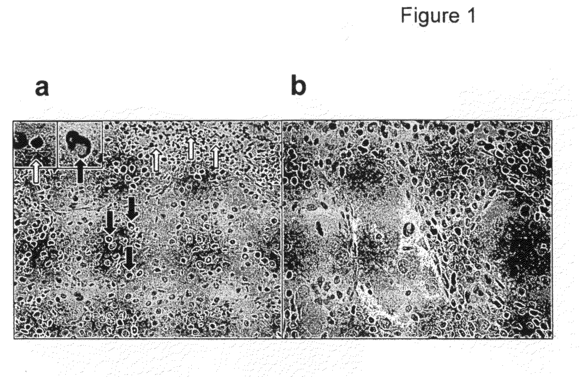 Expression of FoxP3 by cancer cells